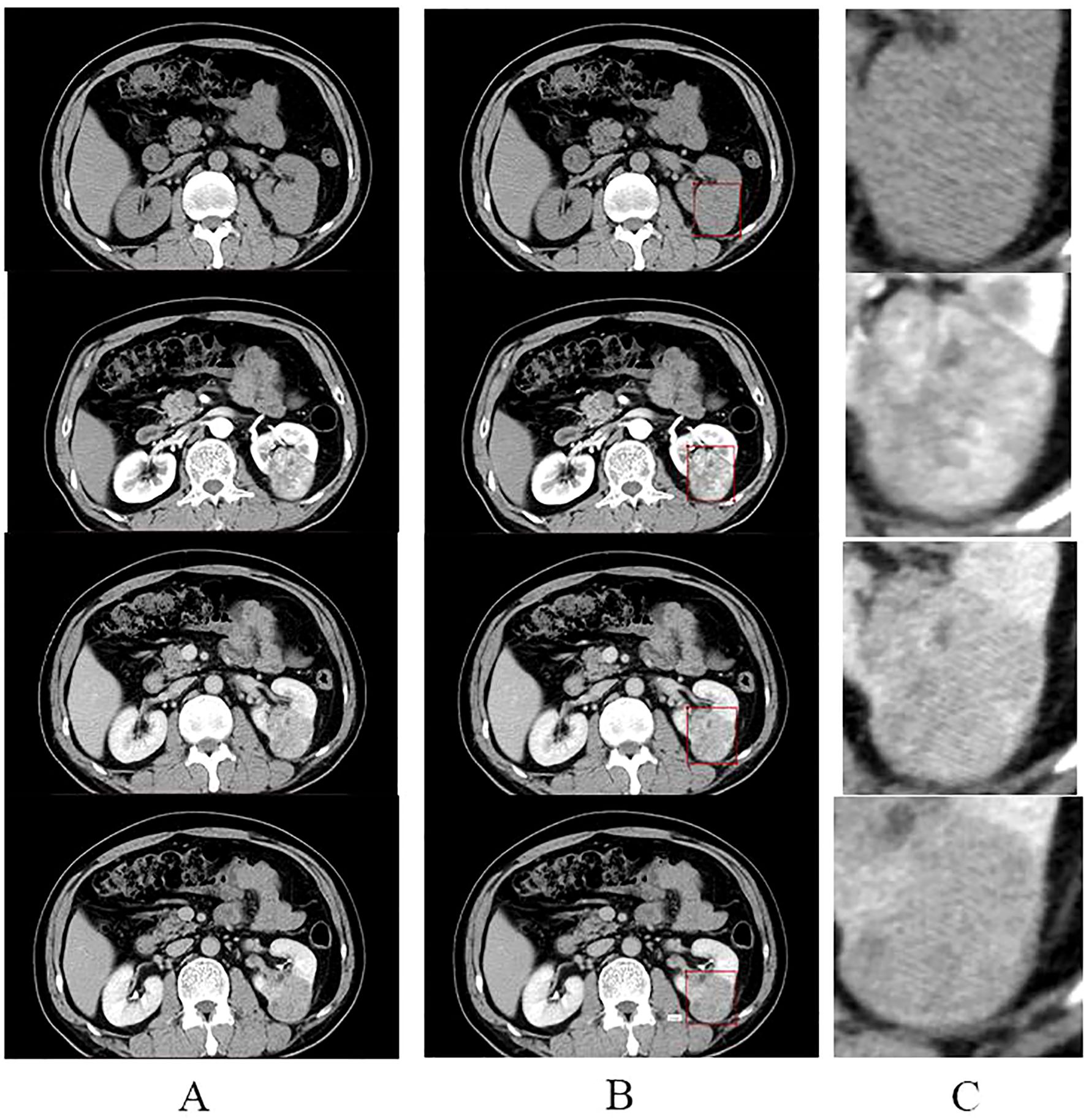 CT scan images showing three columns labeled A, B, and C. Columns A and B display abdominal scans with circled areas highlighting regions of interest. Column C presents close-up views of the highlighted areas in columns A and B, showing detailed textures and structures.