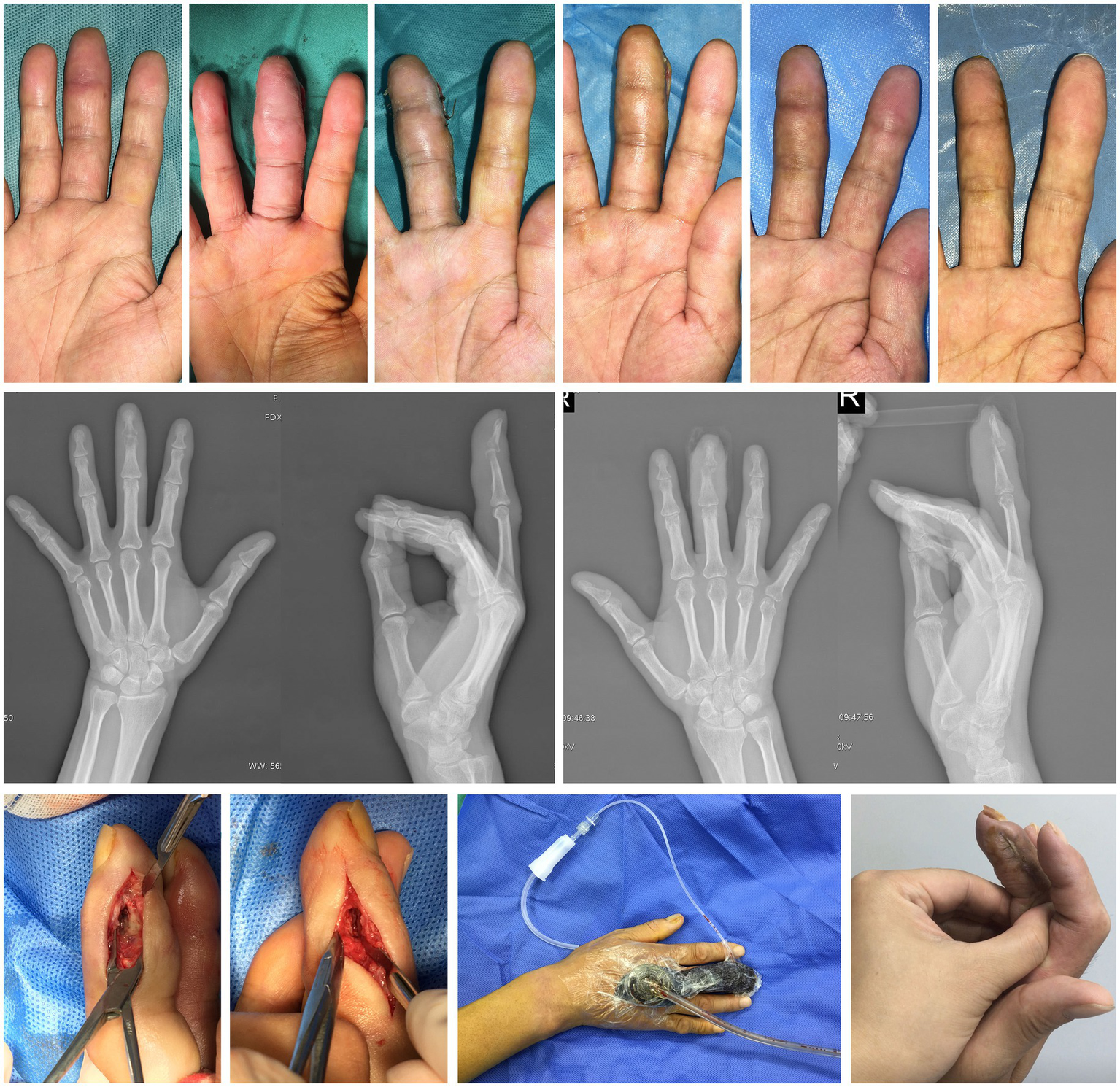 A series of images demonstrates the progression of the finger treatment. The top row shows the progressive changes in the finger during the treatment course. The middle row presents X-ray projections of the hand from different angles before and after treatment. The bottom row illustrates the successful preservation of the patient's right middle finger following surgical exploration, meticulous debridement, NPWT and rehabilitation exercises.