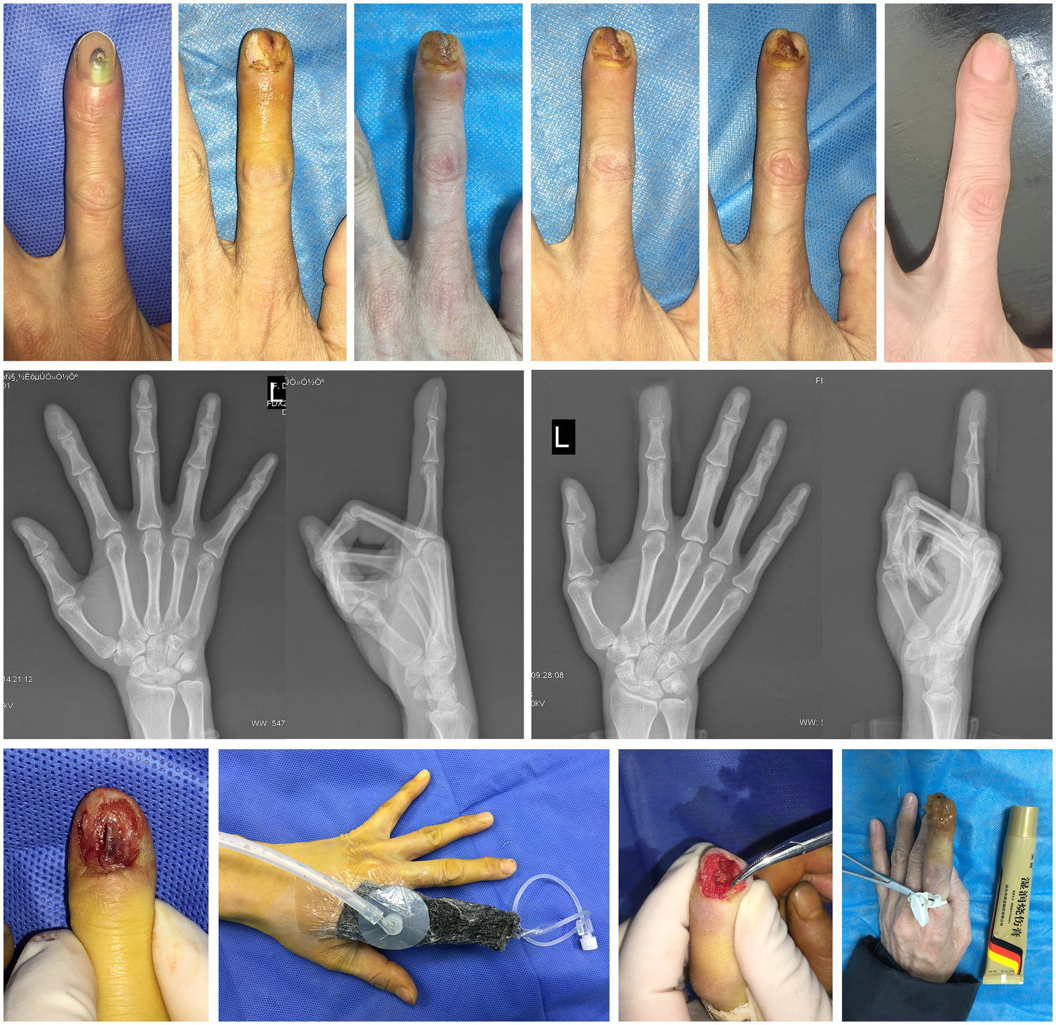 A series of images documenting a finger medical case. The top row demonstrates the progressive healing changes of a finger with a subungual abscess. The middle row displays radiographic images before and after treatment. The bottom row illustrates the complete recovery process achieved through nibbling debridement of necrotic tissue combined with NPWT and MEBO application.