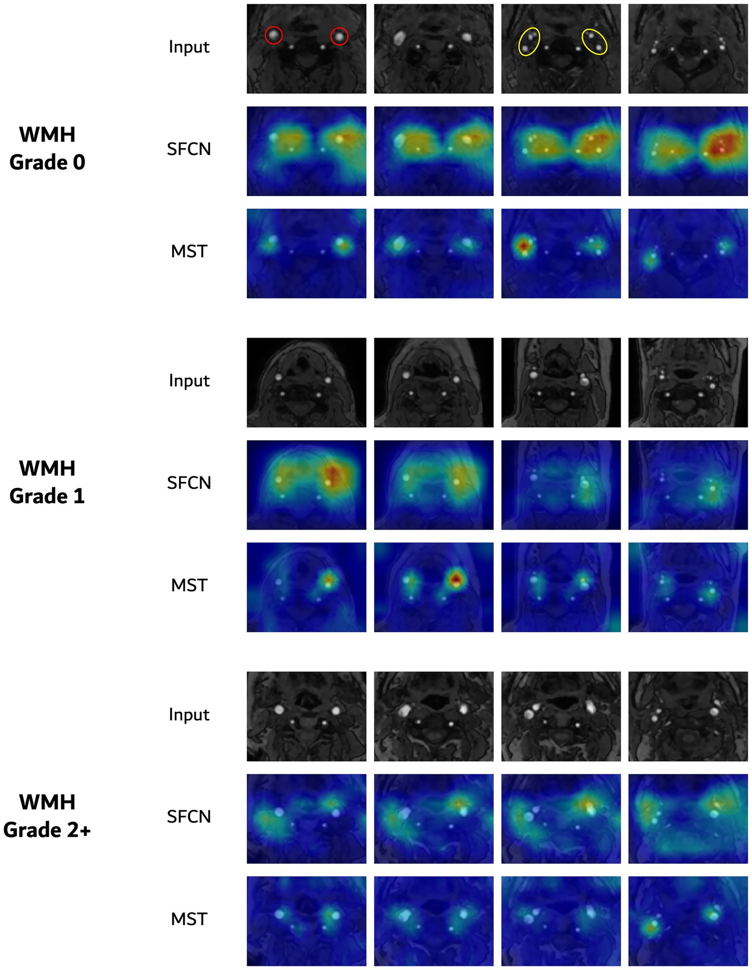 Brain scan images showcase WMH (White Matter Hyperintensity) graded as 0, 1, and 2+. Each grade has three series: input scans, SFCN heatmaps, and MST heatmaps. SFCN and MST visualize differing levels of intensity, highlighting neurological differences across grades.