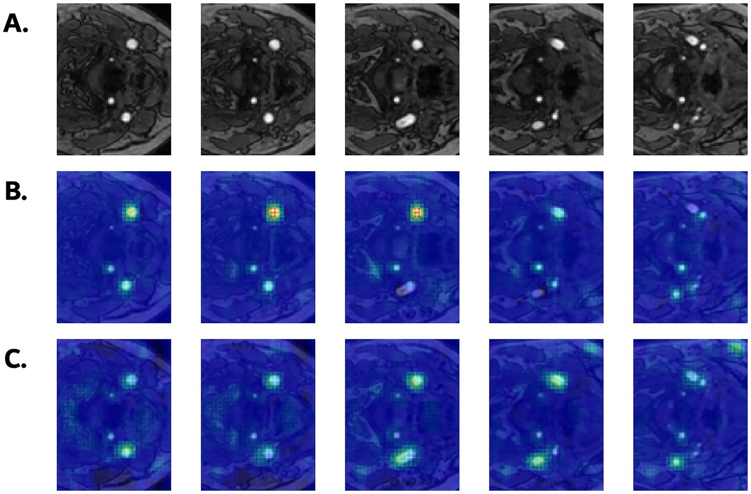 Medical imaging panels showing different MRI scans. Panel A displays grayscale MRI images with varying brightness. Panel B shows the same images with a color overlay indicating areas of intensity, varying from blue to bright yellow. Panel C features a similar color map with subtle differences in highlighted areas. Each row contains five images for comparative analysis.