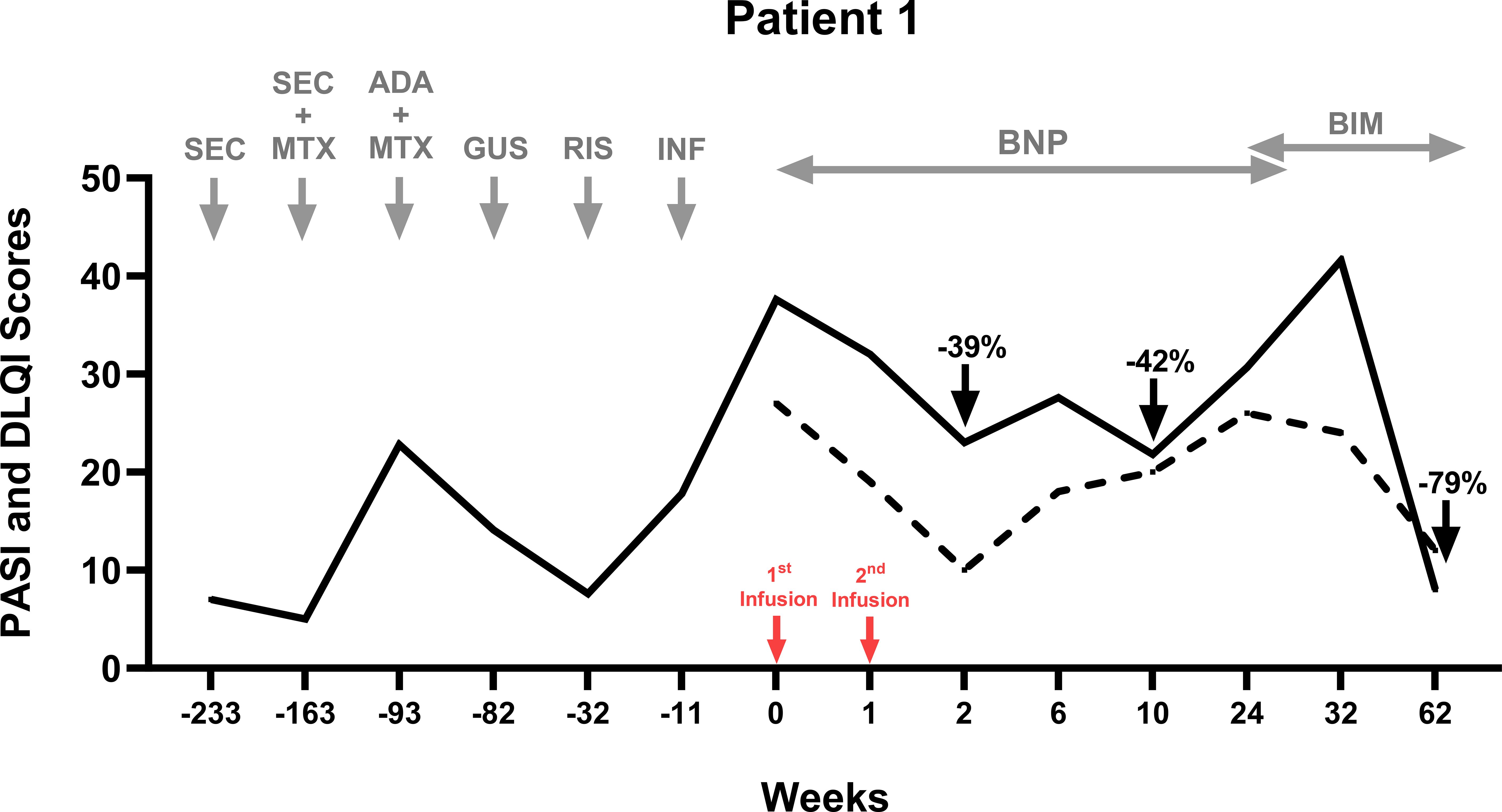 Therapeutic timeline of Patient 1. Line graph shows PASI and DLQI scores over time in weeks. Previous treatments include SEC, MTX, ADA, GUS, RIS, INF, BNP, and BIM. UC-MSCs were administered as an adjuvant therapy alongside Benepali (an etanercept biosimilar) at weeks 0 and one. Benepali was switched to a new biologic—bimekizumab—at Week 24. There are noted score reductions, with percentages marked at 39%, 42%, and 79% from baseline. Infusions occur at weeks zero and one. ADA, adalimumab; BIM, bimikizumab; BNP, Benepali (etanercept biosimilar); GUS, guselkumab; INF, infliximab; MTX, methotrexate; RIS, risankizumab; and SEC, secukinumab.