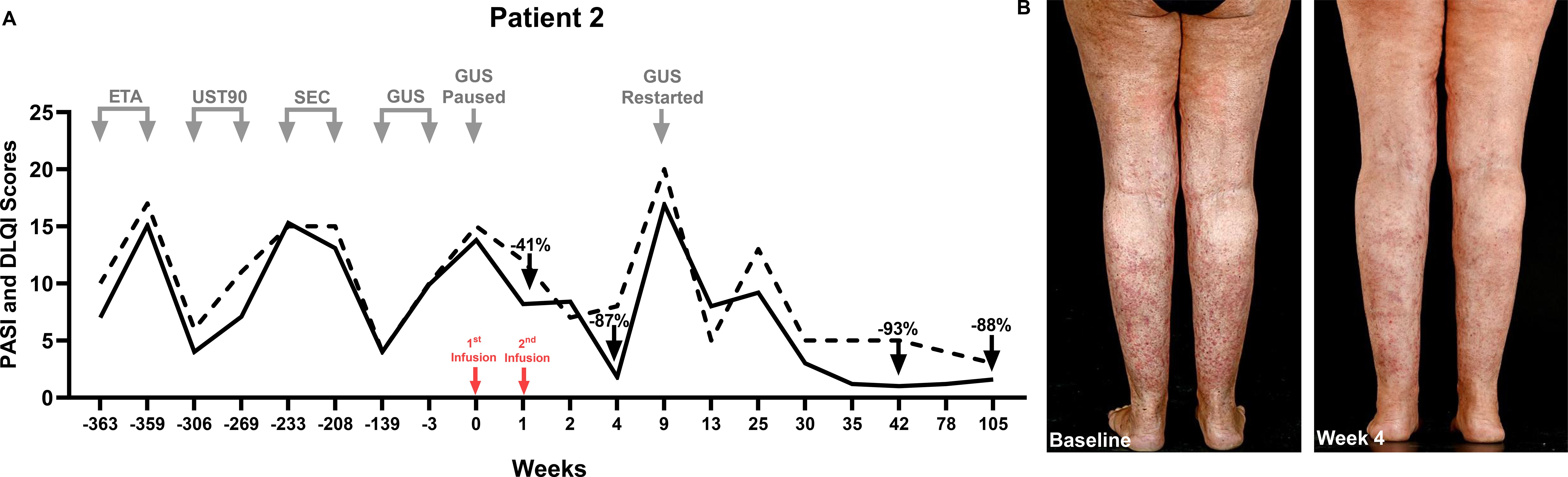 Therapeutic timeline and photos of Patient 2. Graph (A) shows a fluctuating trend in PASI and DLQI scores over weeks, indicating treatment phases: ETA, UST90, SEC, GUS. UC-MSCs were administered as a monotherapy after 8 weeks of washout from GUS. Scores decrease significantly after MSC infusions and subsequent reinitiation of previously failed GUS upon flare (absolute PASI remained <2 for over 2 years since MSC infusions). Photos (B) show the patient's legs at baseline and at week 4, with visible skin improvement by week 4. ETA: Etanercept; GUS: Guselkumab; SEC: Secukinumab; UST90: Ustekinumab 90mg dose.