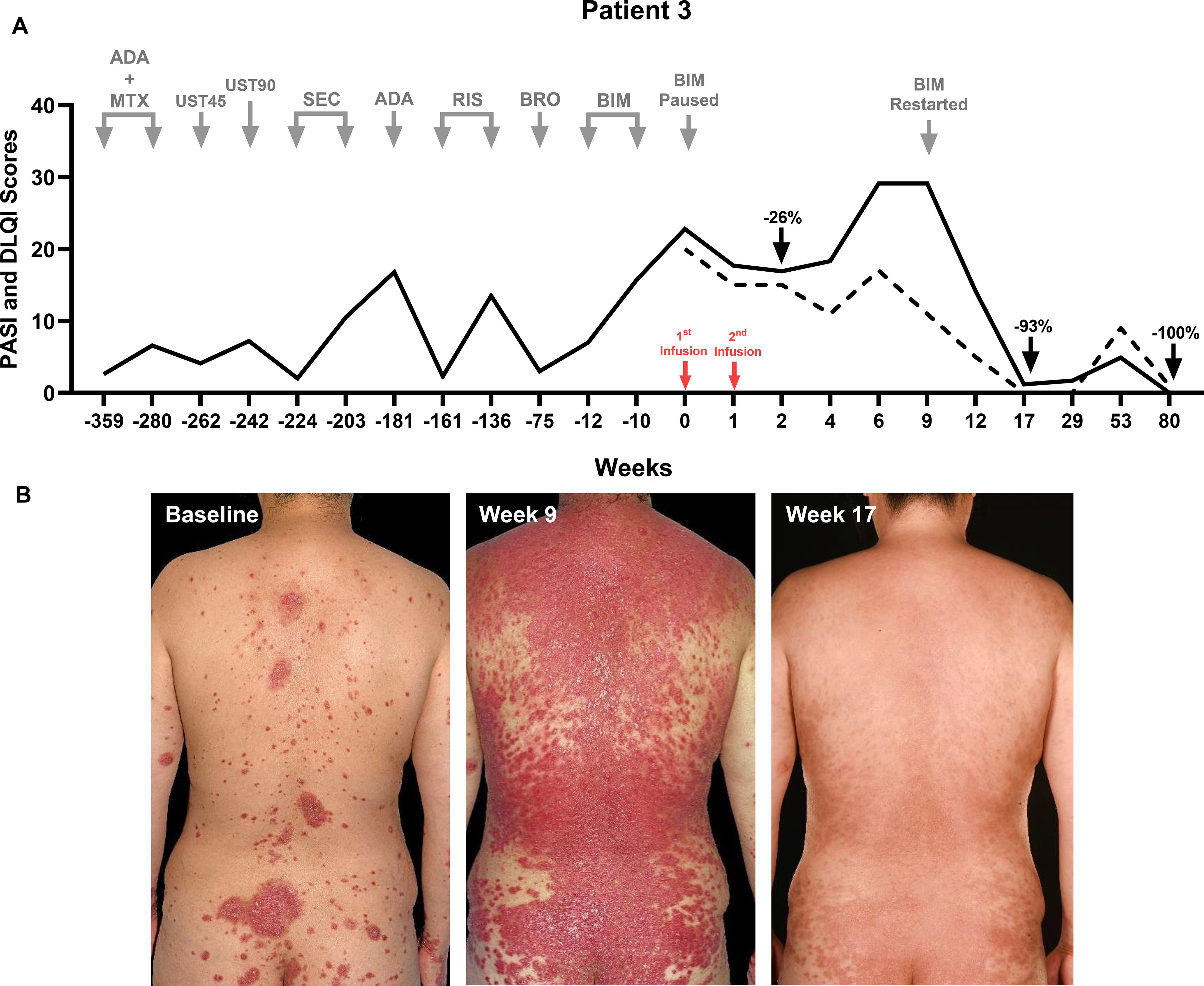 Therapeutic timeline and photos of Patient 3. Graph (A) a fluctuating trend in PASI and DLQI scores over weeks, noting previously failed biologics. UC-MSCs were administered as a monotherapy after 8 weeks of washout from BIM, with significant score drops after subsequent BIM reinitiation upon psoriasis flare. Photos (B) show baseline, severe inflammatory flare at Week 9, and significant clearing at Week 17 after reinitiation of a previously failed biologic BIM. ADA: Adalimumab; BIM: Bimekizumab; BRO: Brodalumab; MTX: Methotrexate; RIS: Risankizumab; SEC: Secukinumab; UST45: Ustekinumab 45mg dose; UST90: Ustekinumab 90mg dose.