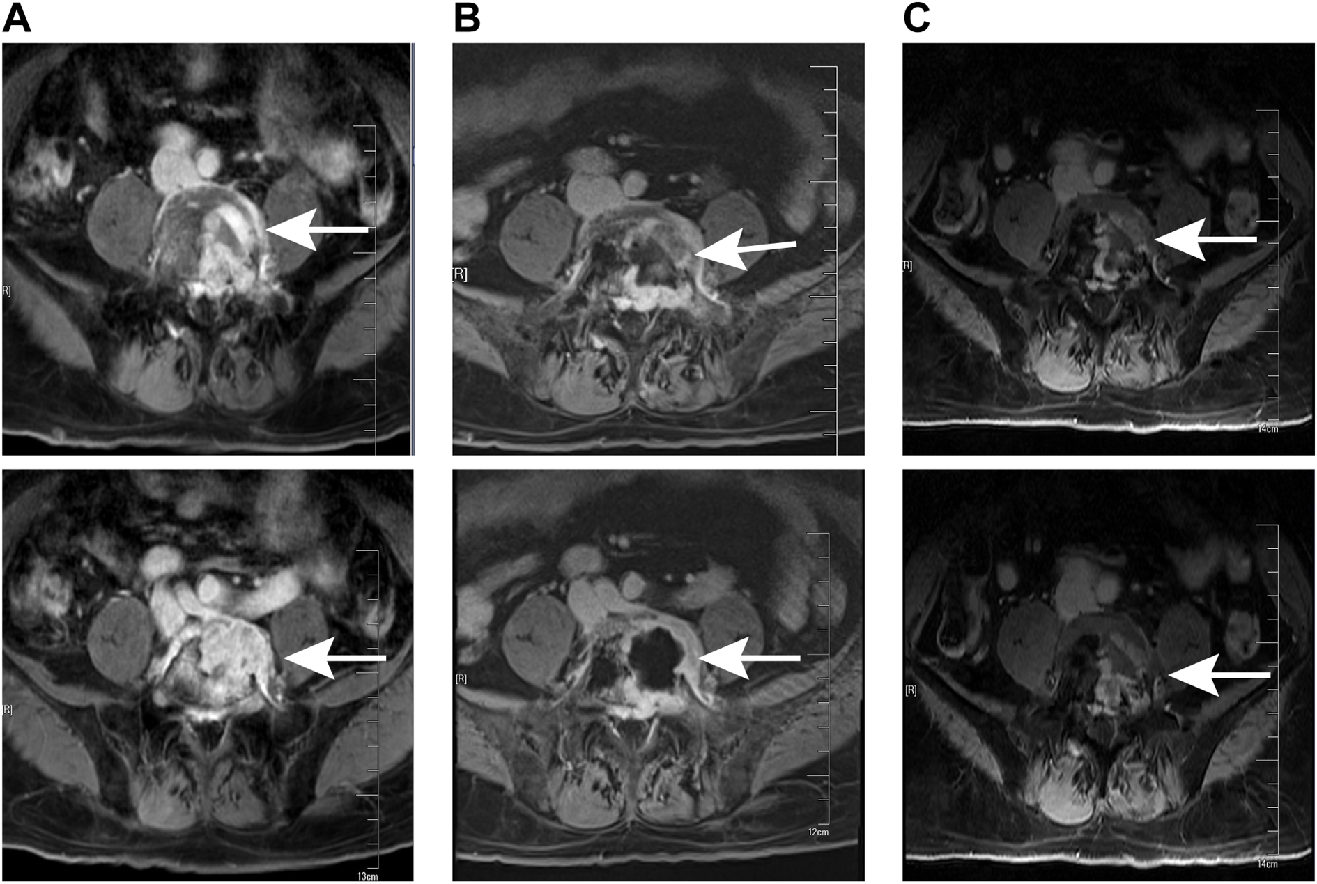 MRI scans showing axial views of the abdomen in three panels labeled A, B, and C. Each panel has two images, highlighting a central area with a white arrow indicating a region of interest. The images display variations in tissue density.