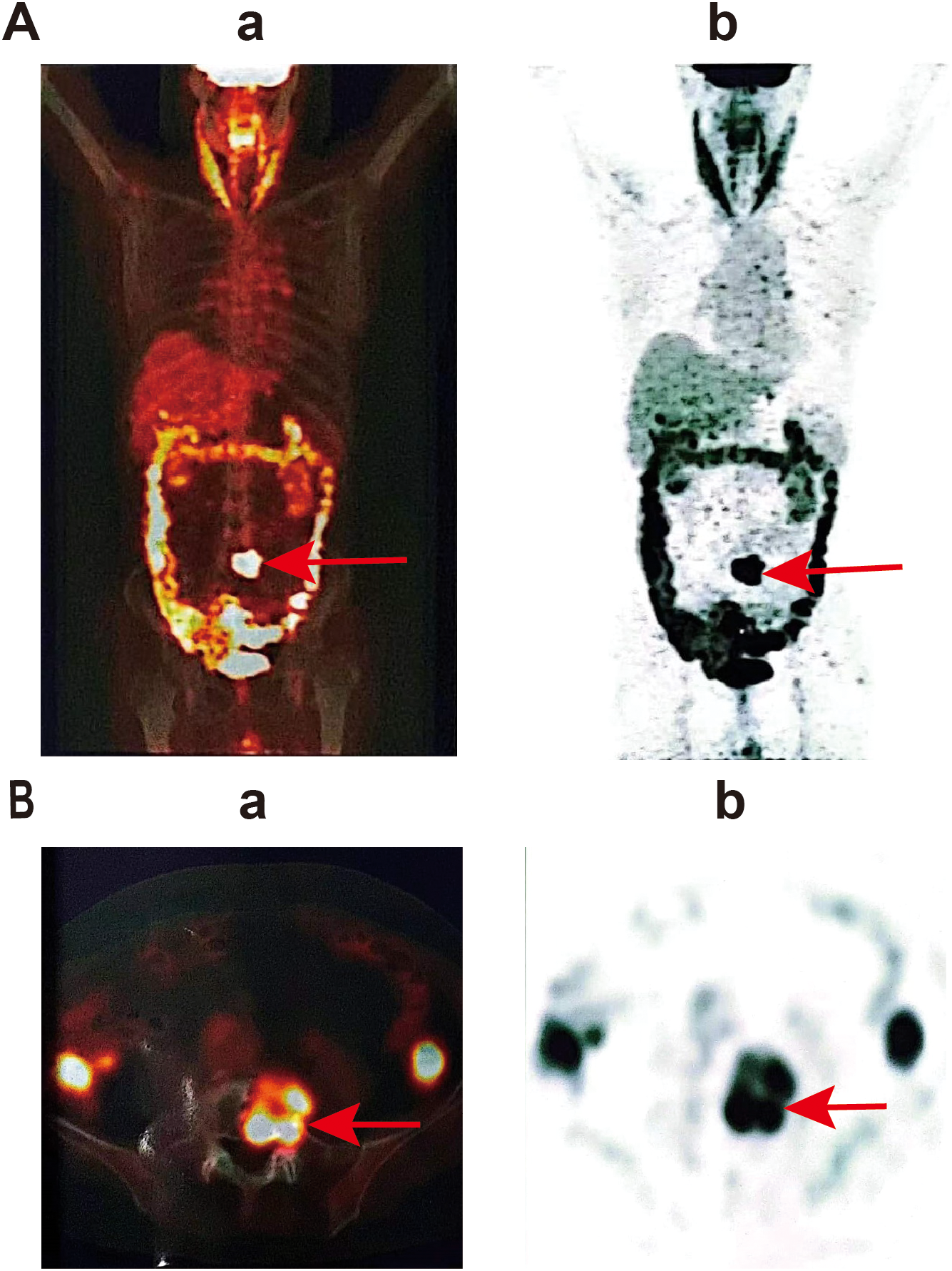 Medical imaging showing two sets of scans labeled A and B. Panel A includes two full-body scans: (a) a color PET scan highlighting metabolic activity, with a red arrow pointing to the abdomen; (b) a grayscale PET scan with a red arrow indicating the same area. Panel B includes two cross-sectional images of the pelvic area: (a) a color PET scan showing metabolic hotspots with a red arrow pointing to a specific region; (b) a corresponding grayscale scan with an arrow marking the same location.