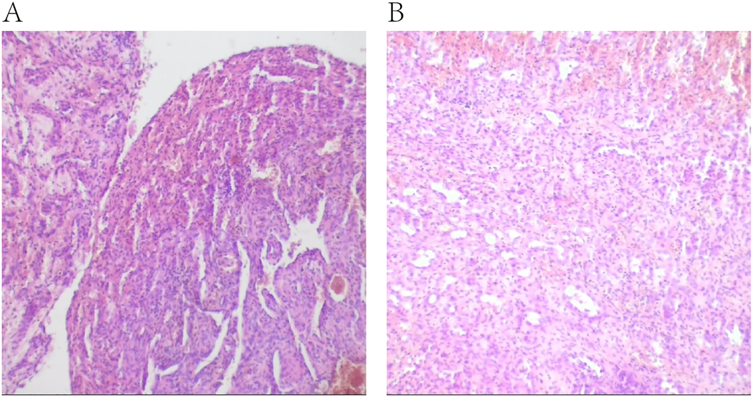 Panel A shows a histological image of tissue with dense, compact cell structures stained purple. Panel B depicts a similar tissue sample with more dispersed cellular arrangement, also stained in purple tones.