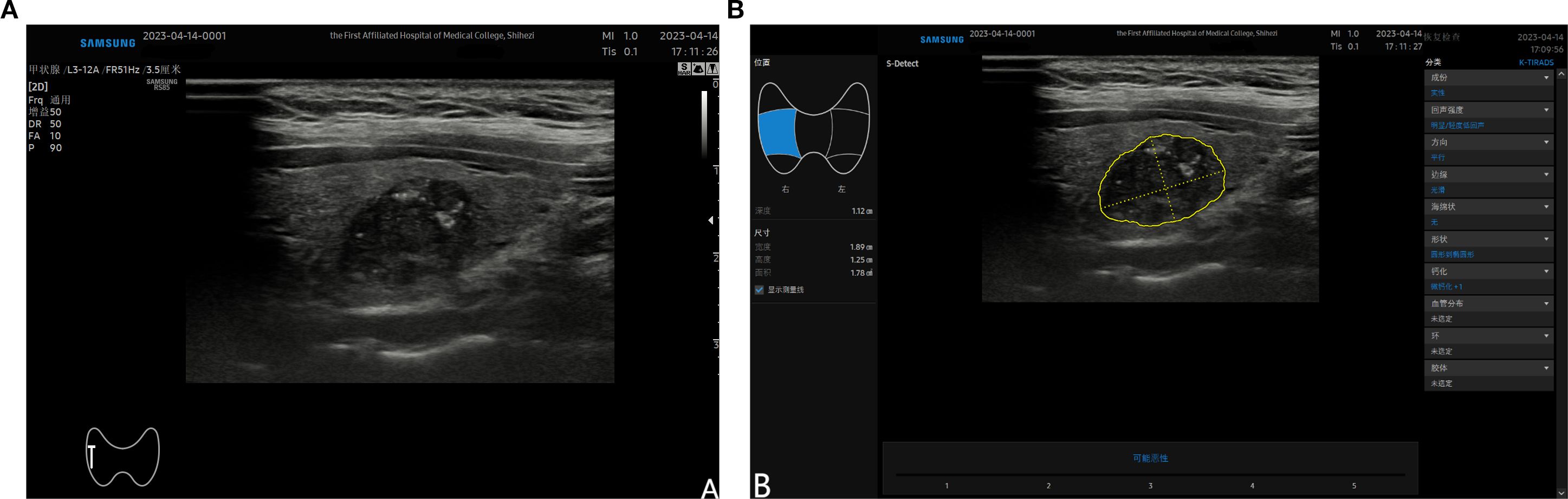 Ultrasound images labeled A and B show a cross-sectional view of tissue. Image A displays an unlabeled scan, while Image B highlights a section circled in yellow, accompanied by measurement details on the right side of the image.