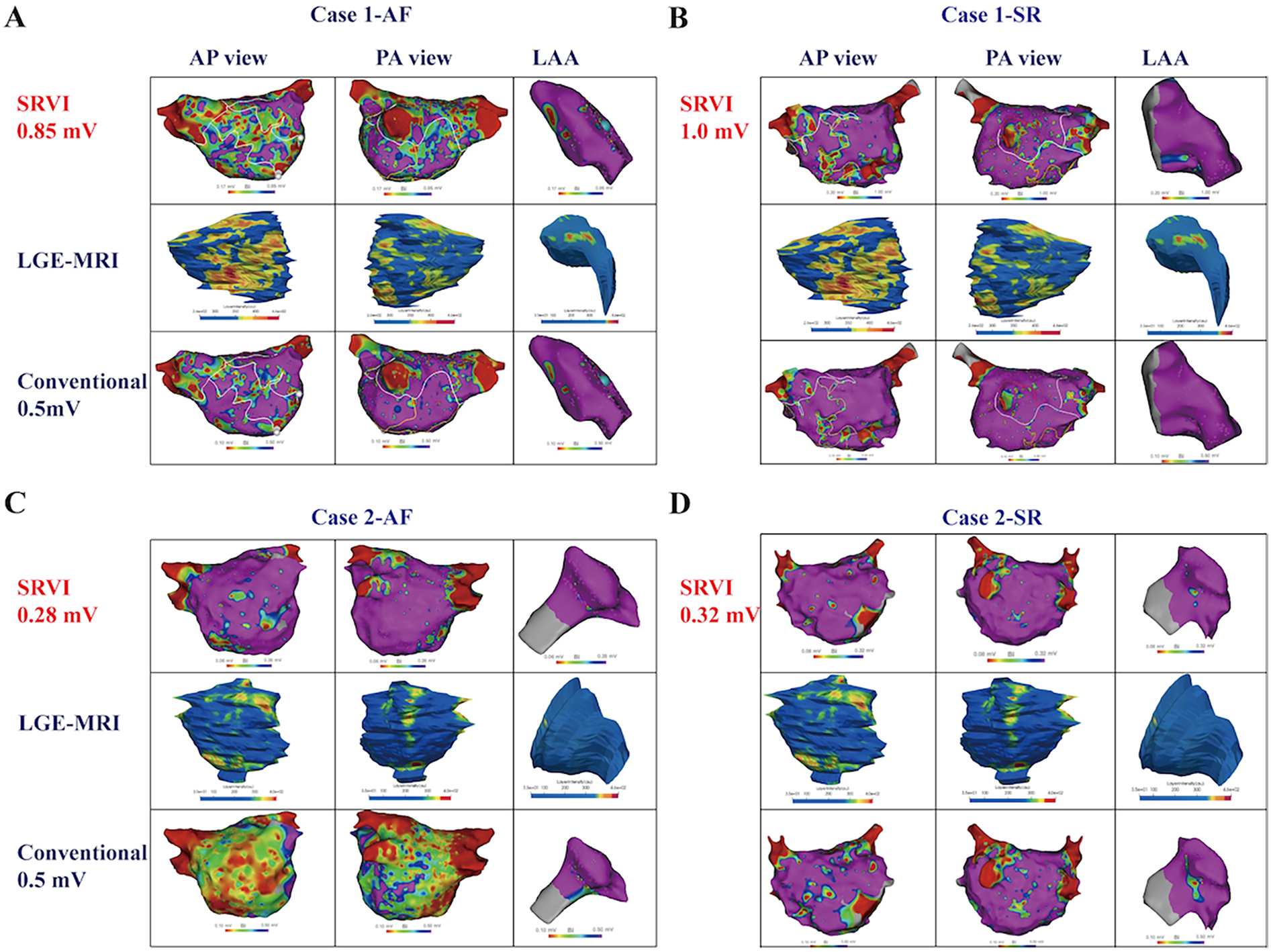 Four sections labeled A, B, C, and D display 3D heart model comparisons with different parameters: SRVI, LGE-MRI, and Conventional measurements. Each section includes anterior-posterior, posterior-anterior, and LAA views, illustrating variations in visualization for cases of AF and SR, alongside specific SRVI values in millivolts.