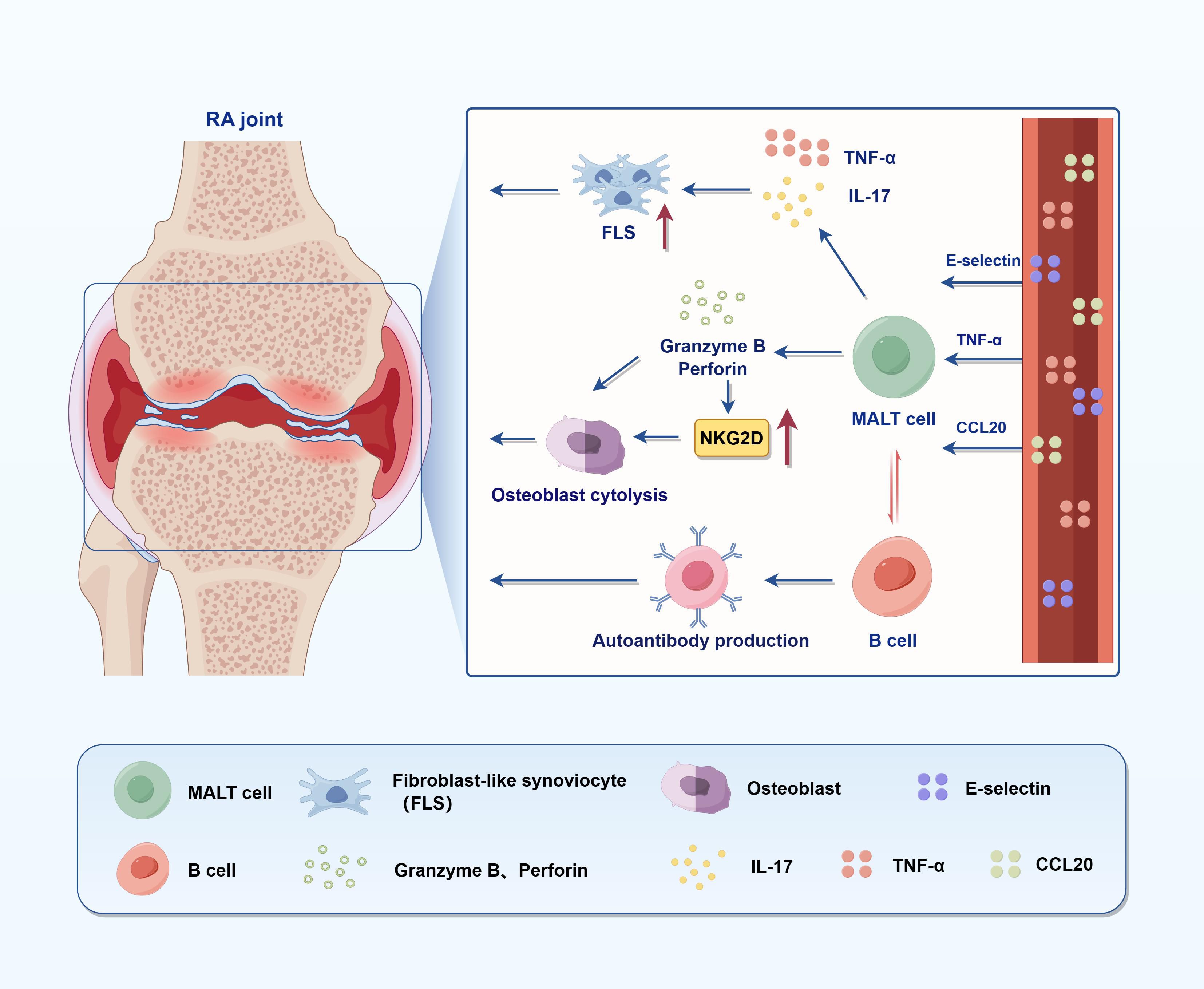 Diagram of RA joint inflammation shows cellular interactions. Fibroblast-like synoviocytes produce TNF-α and IL-17 affecting MALT cells. Granzyme B and perforin induce osteoblast cytolysis via NKG2D. B cells produce autoantibodies. E-selectin and CCL20 are involved in the process. Key: MALT and B cells, fibroblast-like synoviocyte, osteoblast, E-selectin, granzyme B, perforin, IL-17, TNF-α, CCL20.