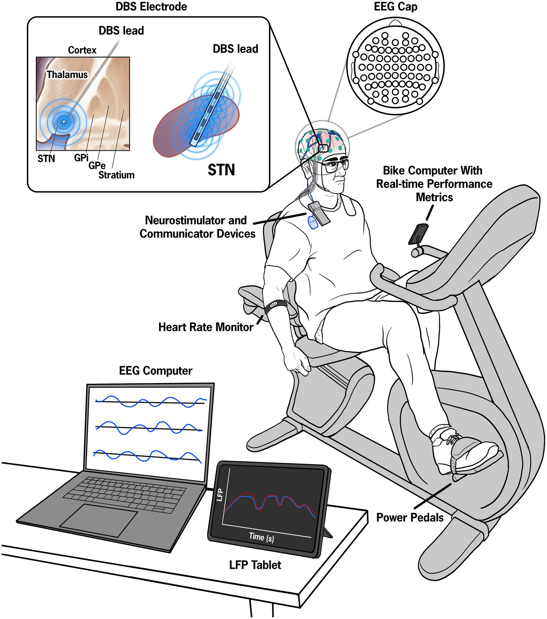 Illustration of experimental set up which shows a person exercising on a cycling machine. The person has EEG electrodes placed on the surface of his head and DBS electrodes implanted bilaterally in the subthalamic nucleus (STN). The setup includes a neurostimulator, communicator devices, heart rate monitor, real-time performance metrics on a bike computer, and a tablet displaying local field potential (LFP) data.