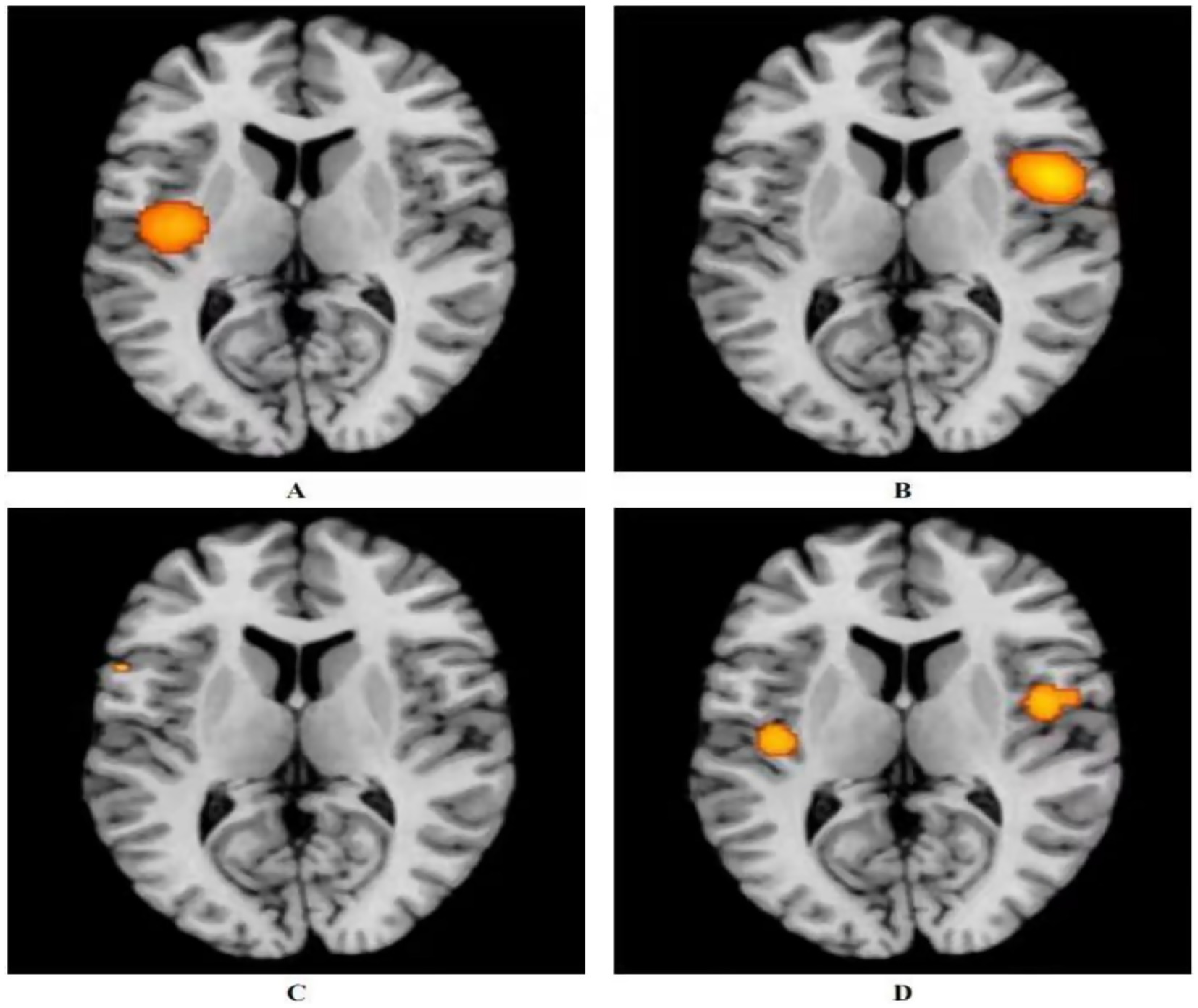 Four brain scans labeled A, B, C, and D show different regions of activation. A and C indicate positive activation, while B and D show negative activation. Activation areas are highlighted in orange. Each image corresponds to acupuncture effects in patients with either ANSLBP or CNSLBP.
