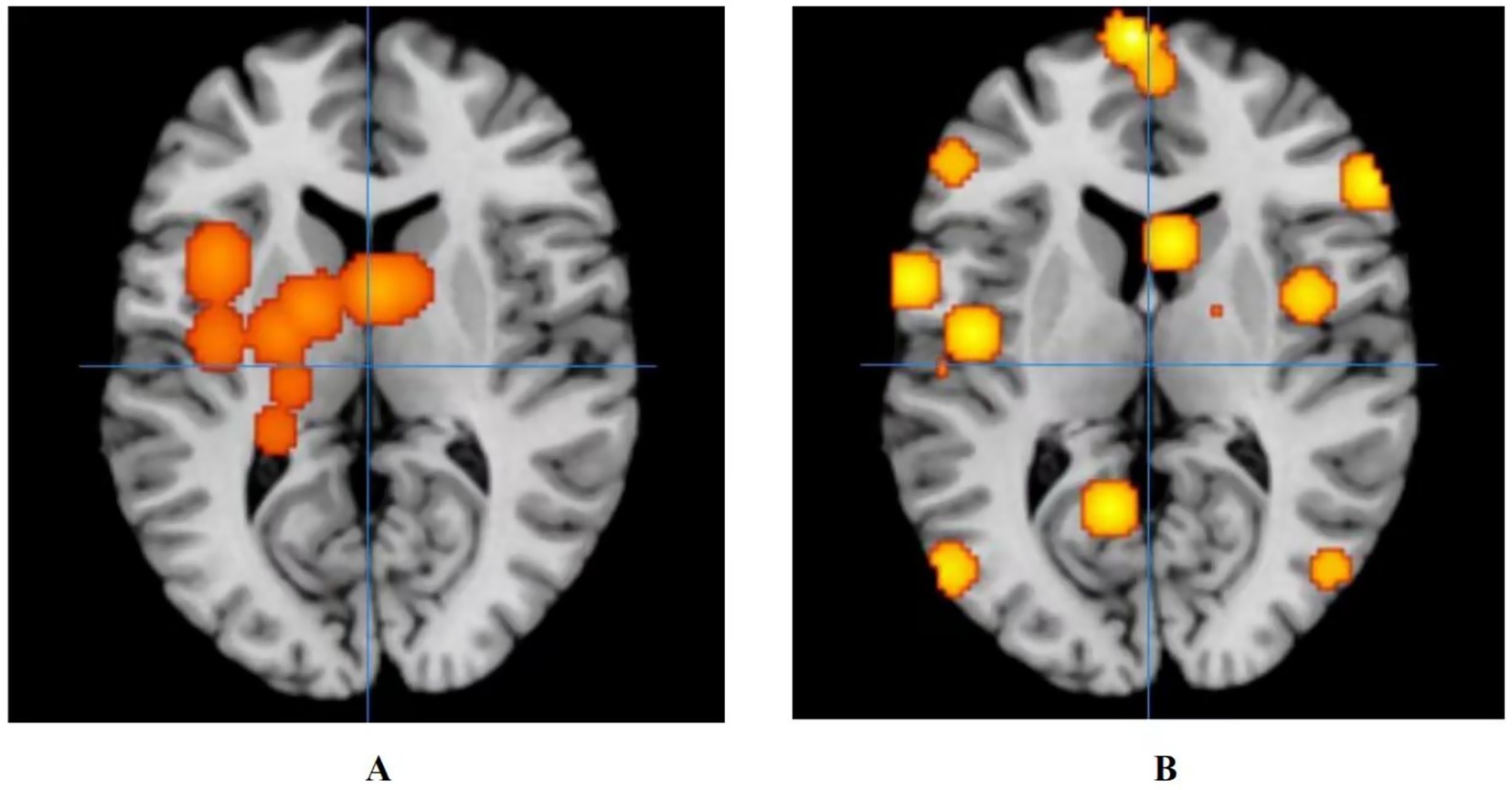 fMRI scans show brain activations in two conditions. Image A displays clustered orange-highlighted regions in the central brain. Image B shows dispersed orange-activated regions in various brain areas. Blue crosshairs mark reference points.
