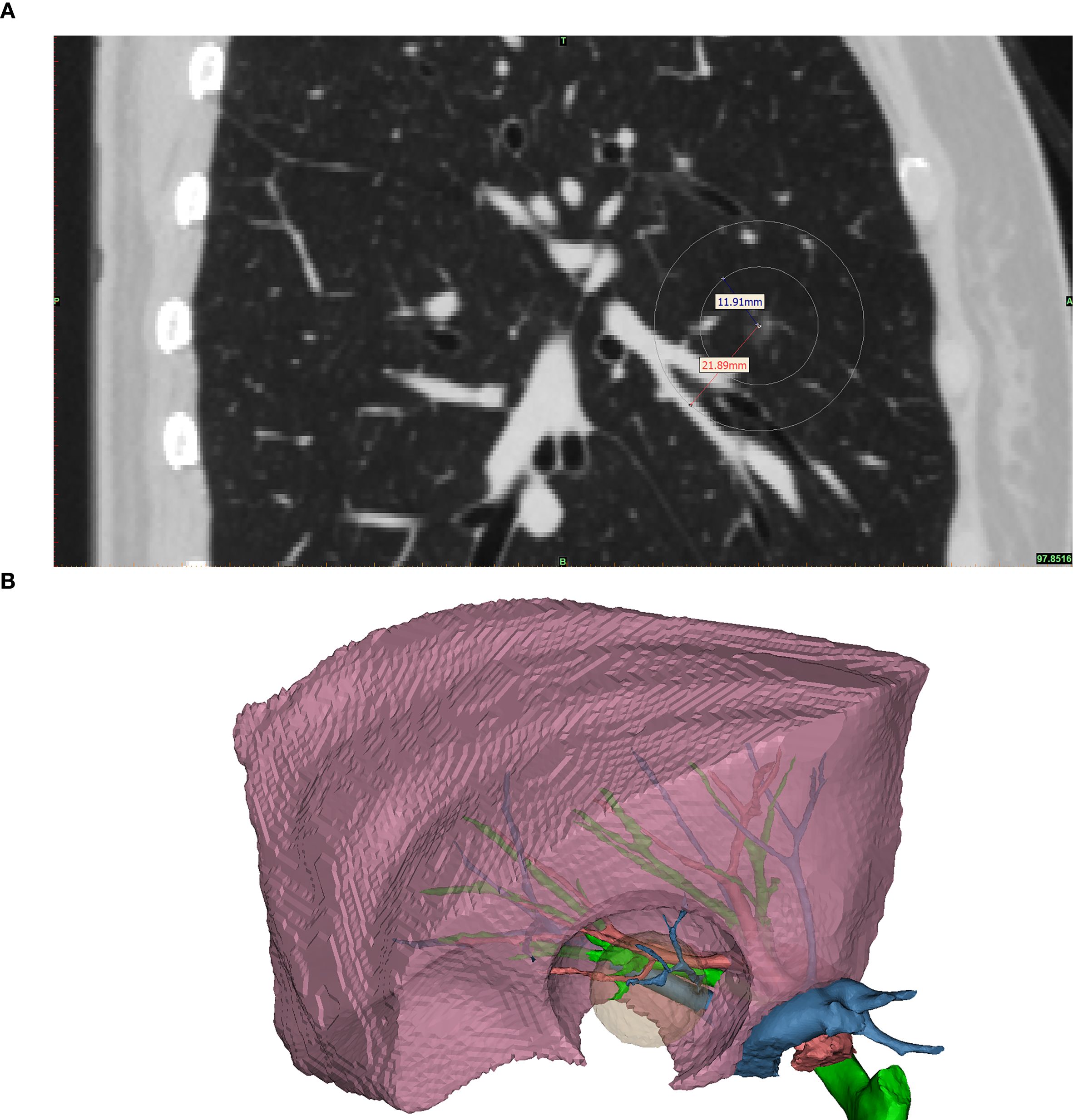 Panel A shows a CT scan of a lung with a nodule measuring 21.89 millimeters inside a circle, and a smaller nearby spot labeled 11.91 millimeters. Panel B illustrates a 3D model of the lung's interior, highlighting bronchial and vascular structures in various colors within a semi-transparent lung section.