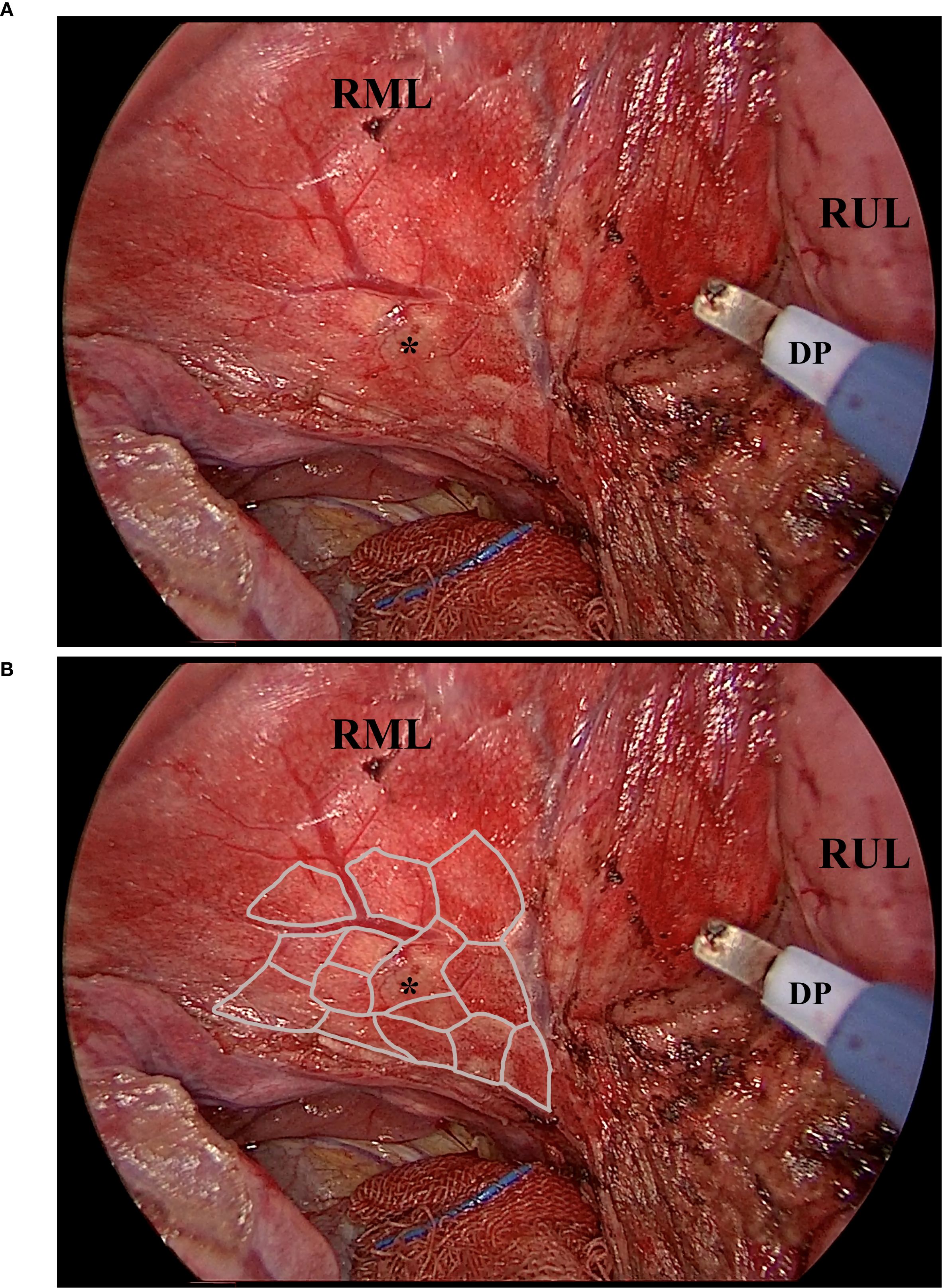 Two endoscopic images labeled A and B show a surgical view inside the body. Labels include RML (Right Middle Lobe), RUL (Right Upper Lobe), and DP (Diaphragmatic Pleura). In image A, a tool is visible near the pleura. Image B is similar but has a highlighted structure overlaid, delineating regions within the RML. An asterisk marks a specific area in both images.
