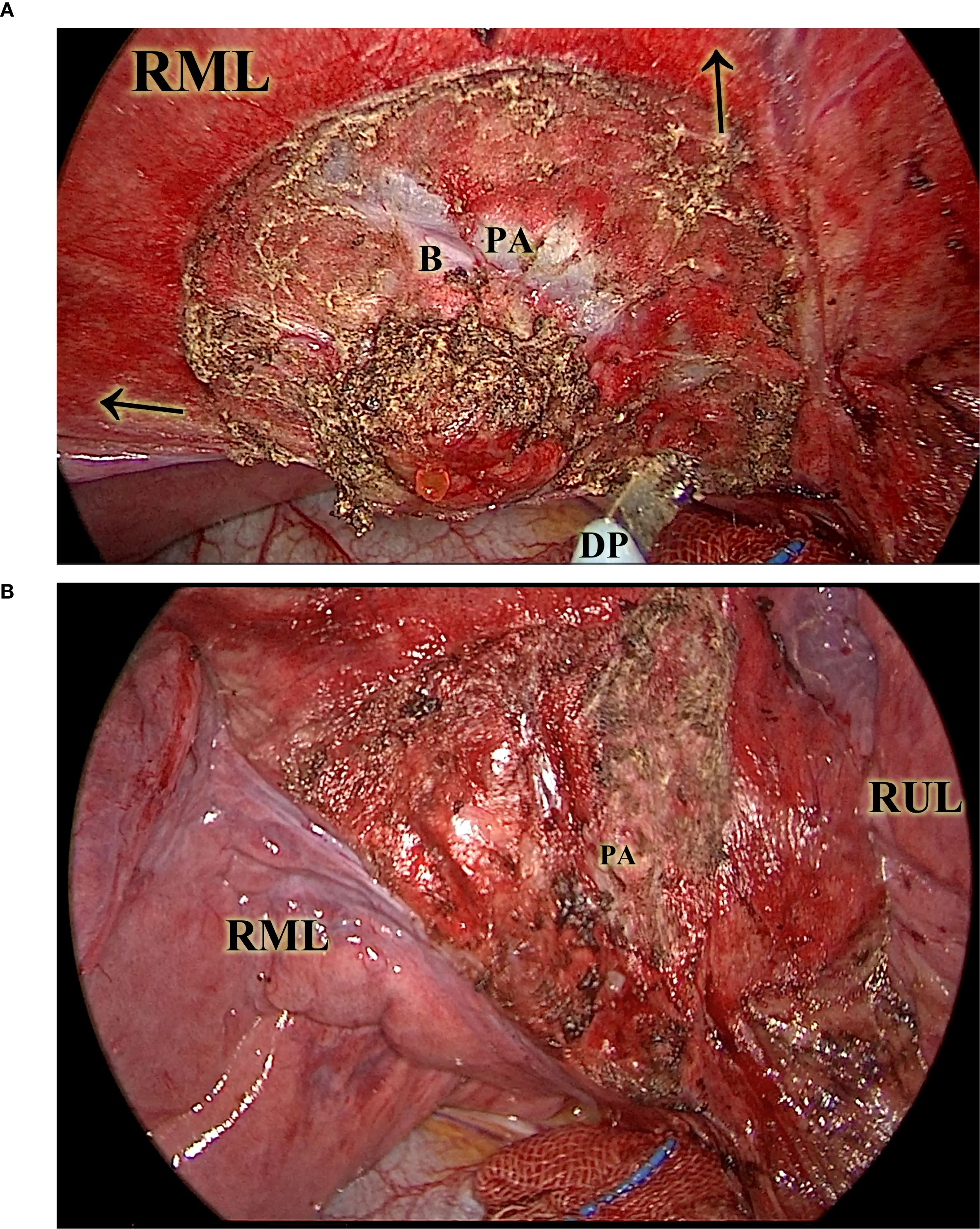 The image consists of two panels labeled A and B, showing a detailed view of a surgical site. Panel A shows a lesion within the right middle lobe (RML) of the lung with labels for structures such as PA (pulmonary artery), B (bronchus), and DP (diaphragm). Panel B highlights the affected area, labeled RML and RUL (right upper lobe), with visible tissue discoloration and anatomical labels. The site appears red and inflamed with signs of necrotic tissue.