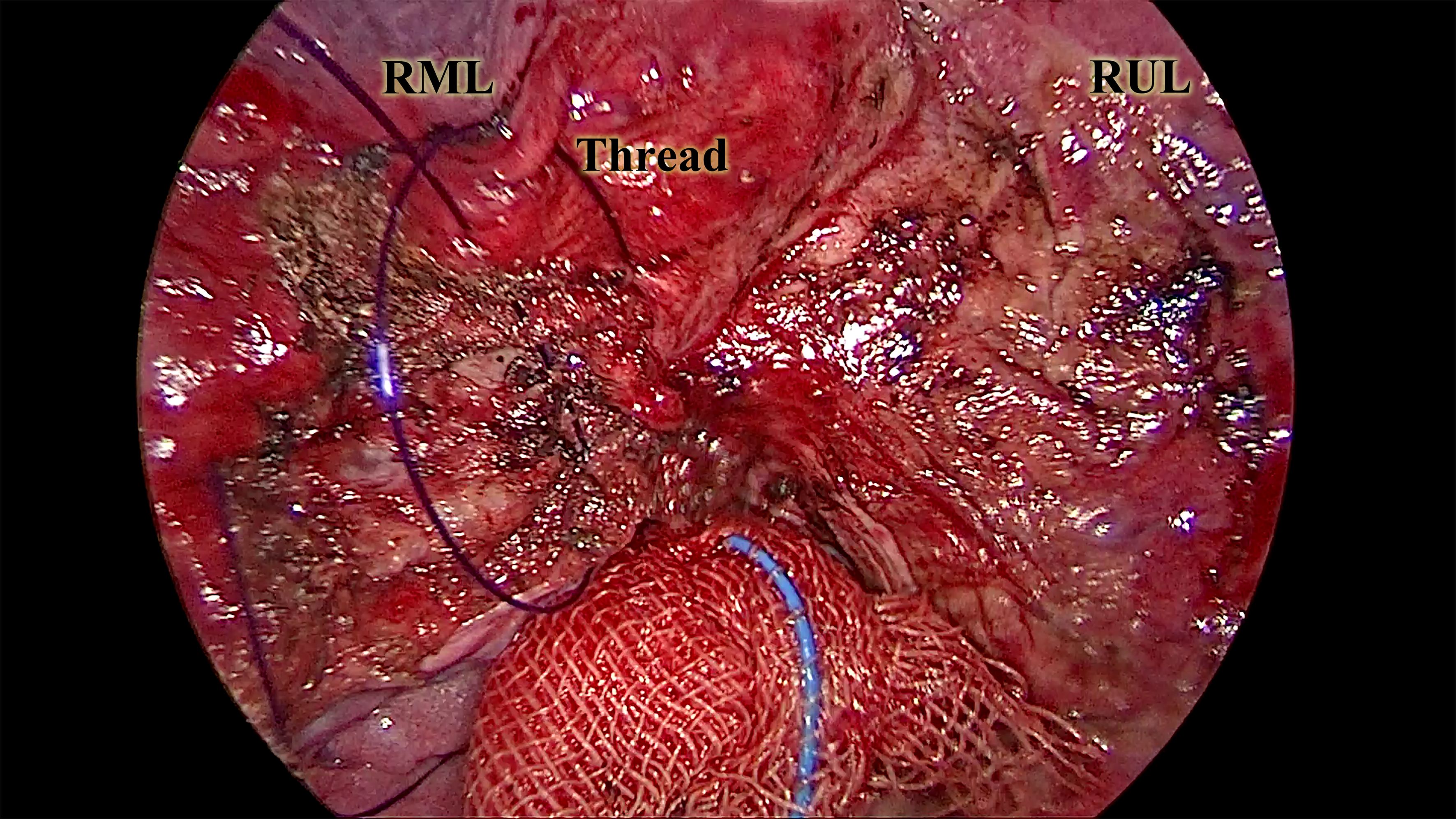 Endoscopic image showing a section of the lungs with labels “RML,” “RUL,” and “Thread” indicating regions and sutures. The tissue appears red and intricate, with visible thread and mesh near the lower center.
