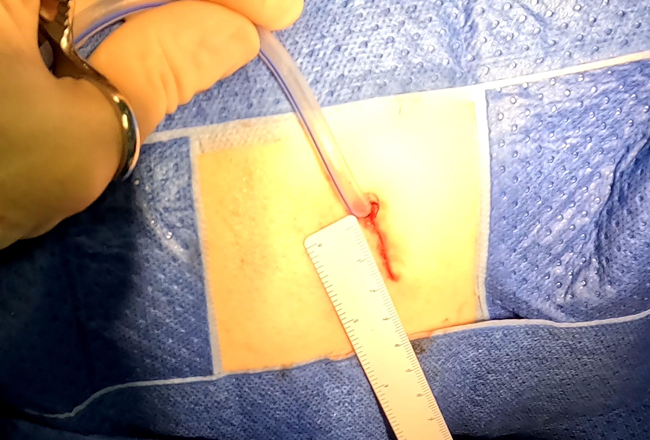 A hand, wearing gloves, holding a surgical tool near a partially exposed wound on a person's skin, with a tube inserted into the wound. A ruler is used to measure the incision length, and the area is draped with sterile blue cloth.
