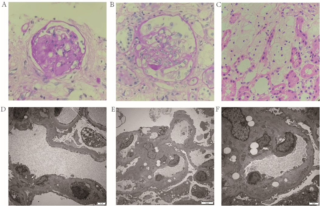 Six-panel image displaying kidney histology and electron micrographs. Panels A, B, C show periodic-acid-Schiff stained tissue with varying glomerular structures. Panels D, E, F depict electron micrographs showing detailed cellular ultrastructure at increasing magnifications. Scale bars are visible in the electron micrographs.