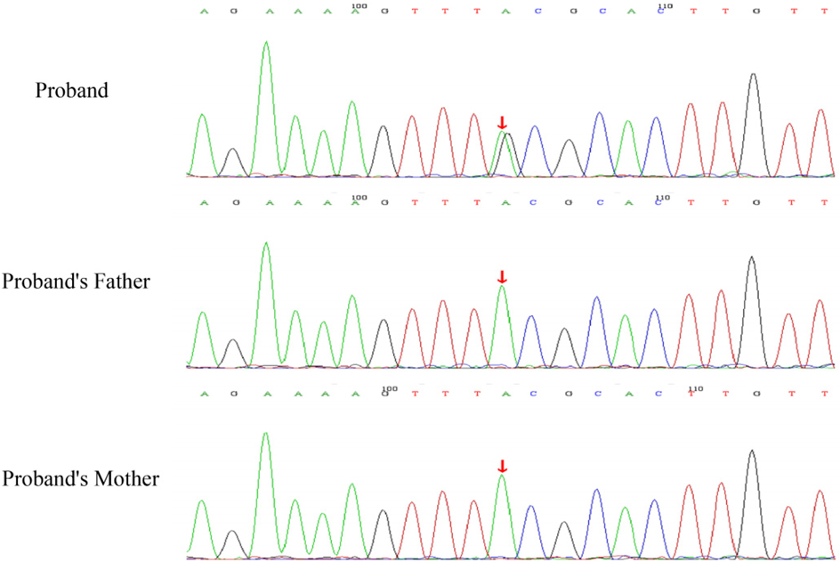 Electropherogram comparison of DNA sequences for a proband and their parents. Each graph displays colored peaks representing nucleotide bases (A, T, C, G). Red arrows highlight specific areas of interest for each subject.