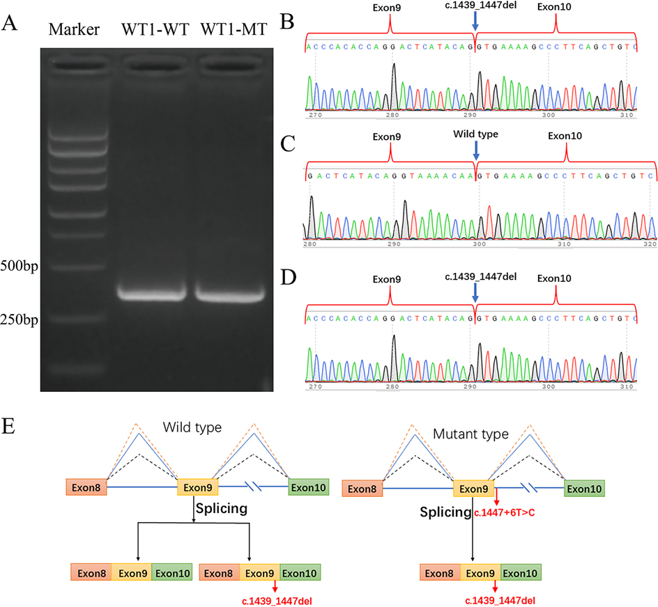 Gel electrophoresis shows markers and bands for WT1-WT and WT1-MT around 250bp. Panels B, C, and D display DNA sequencing chromatograms highlighting exon 9 and exon 10. Mutations c.1439_1447del and c.1447+6T>C are indicated. Panel E shows a diagram comparing wild type and mutant types, illustrating changes in splicing due to mutations impacting exon arrangement.
