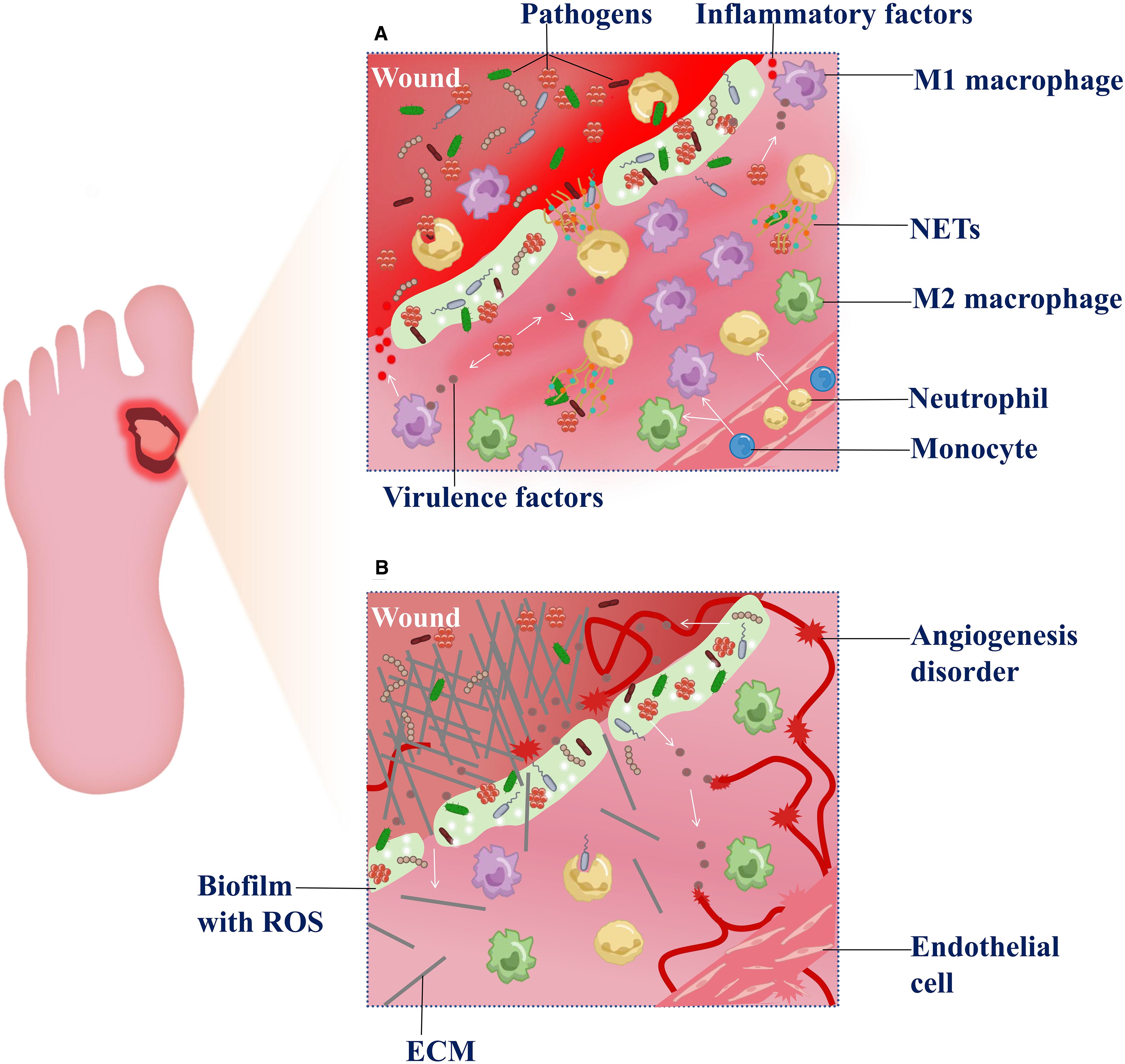Illustration of a foot with an ulcer and two detailed panels showing cellular interactions. Panel A displays pathogen infiltration, inflammatory factors like M1 and M2 macrophages, neutrophils, and monocytes in a wound environment. Panel B depicts biofilm with reactive oxygen species and extracellular matrix, highlighting endothelial cells and angiogenesis disorder within the wound area.