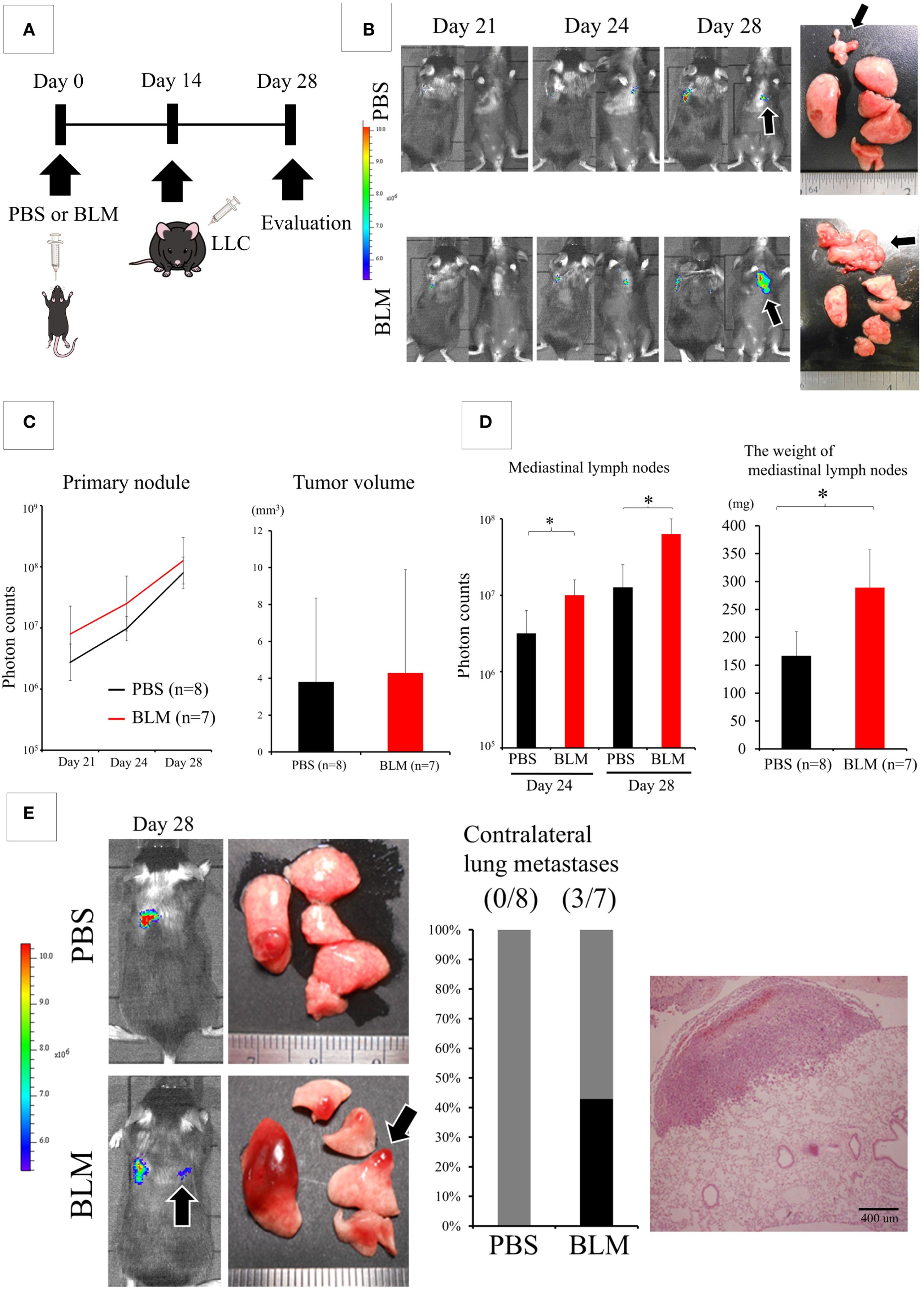Research schematic showing a study on lung cancer progression in mice treated with PBS or BLM. A timeline (A) depicts treatment and evaluation schedule. Imaging (B) shows tumor growth over time, with lungs and lymph nodes highlighted. Graphs (C and D) display data on primary nodules, tumor volume, and mediastinal lymph nodes, indicating significant differences marked by asterisks. Panel E includes lung images from day 28 and a bar graph comparing metastasis rates, alongside a histological slide showing cellular detail at 400 micrometers scale.