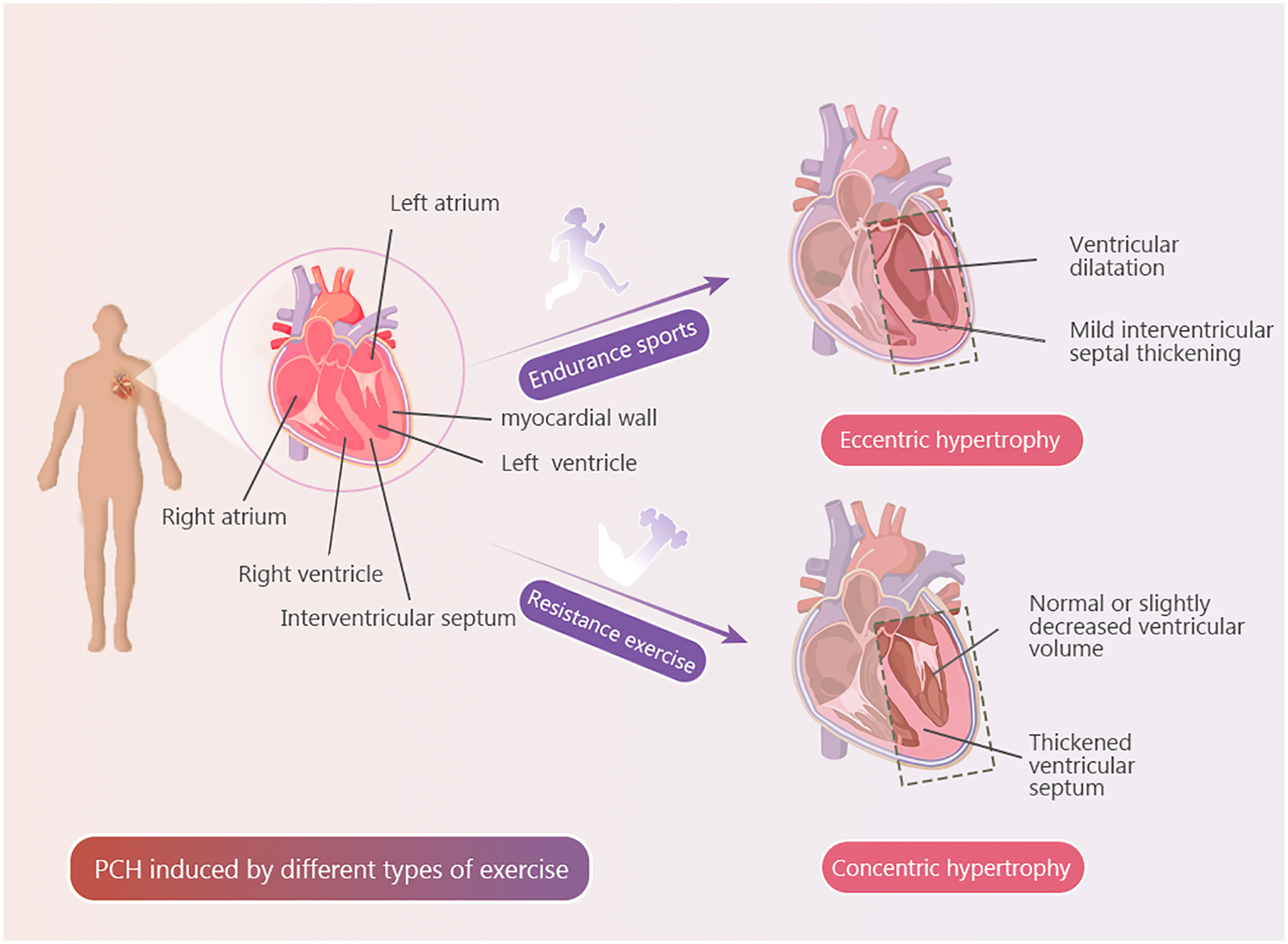 Diagram showing the effects of different types of exercise on the heart. Labels indicate the left atrium, right atrium, left ventricle, right ventricle, and interventricular septum. Endurance sports cause eccentric hypertrophy with ventricular dilation and mild septal thickening. Resistance exercise leads to concentric hypertrophy with a thickened septum and normal or reduced ventricular volume. The title describes PCH induced by exercise.