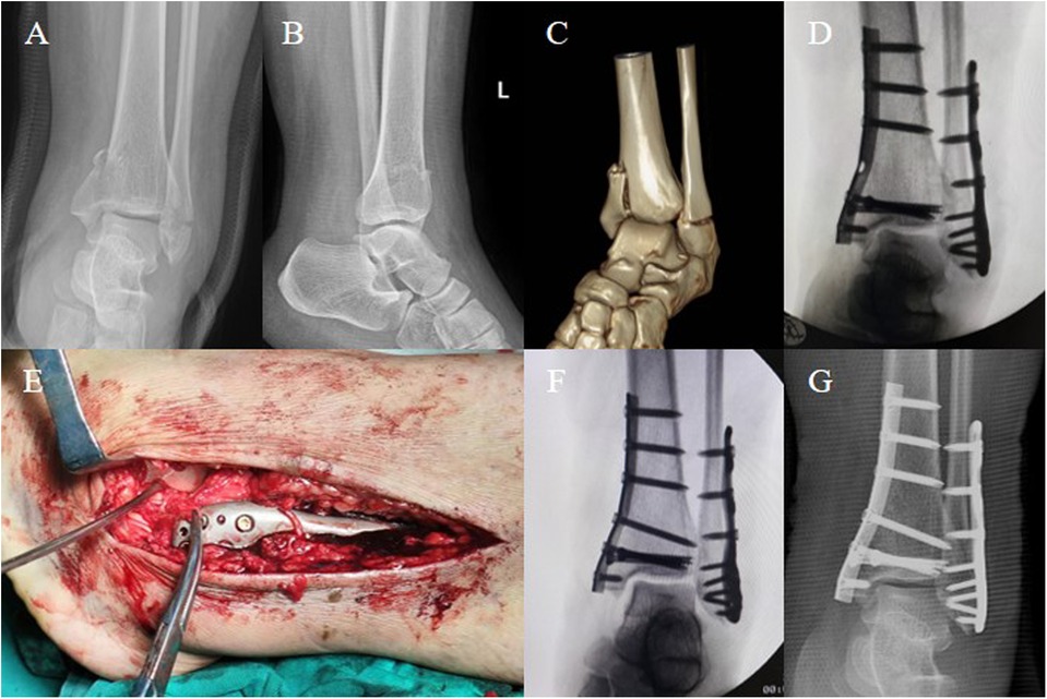 X-ray and surgical images showing steps in ankle fracture treatment. Panels A and B show initial fracture X-rays. Panel C displays a 3D bone model of the fracture. Panel D shows a post-operative X-ray with screws and a plate. Panel E illustrates the open surgical site during fixation. Panels F and G showcase final X-rays with the repaired structure, displaying the alignment and placement of metal hardware.