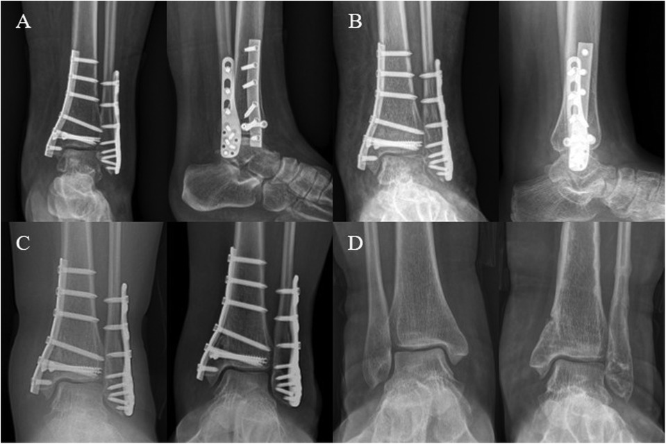 X-ray series of an ankle with surgical hardware. Figure A shows the anterior and lateral views with plates and screws. Figure B displays similar views with additional hardware. Figure C indicates further fixation details. Figure D illustrates the healed joint without hardware.