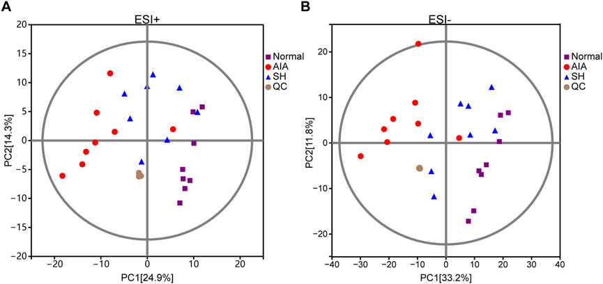 Two plots labeled A and B show PCA results. Plot A (ESI+) has axes PC1 (24.9%) and PC2 (14.3%), while Plot B (ESI-) features PC1 (33.2%) and PC2 (11.8%). Data points are color-coded: purple squares for Normal, red circles for AIA, blue triangles for SH, and brown circles for QC. Each plot displays the distribution of these categories within a circular boundary, with varying clustering patterns.