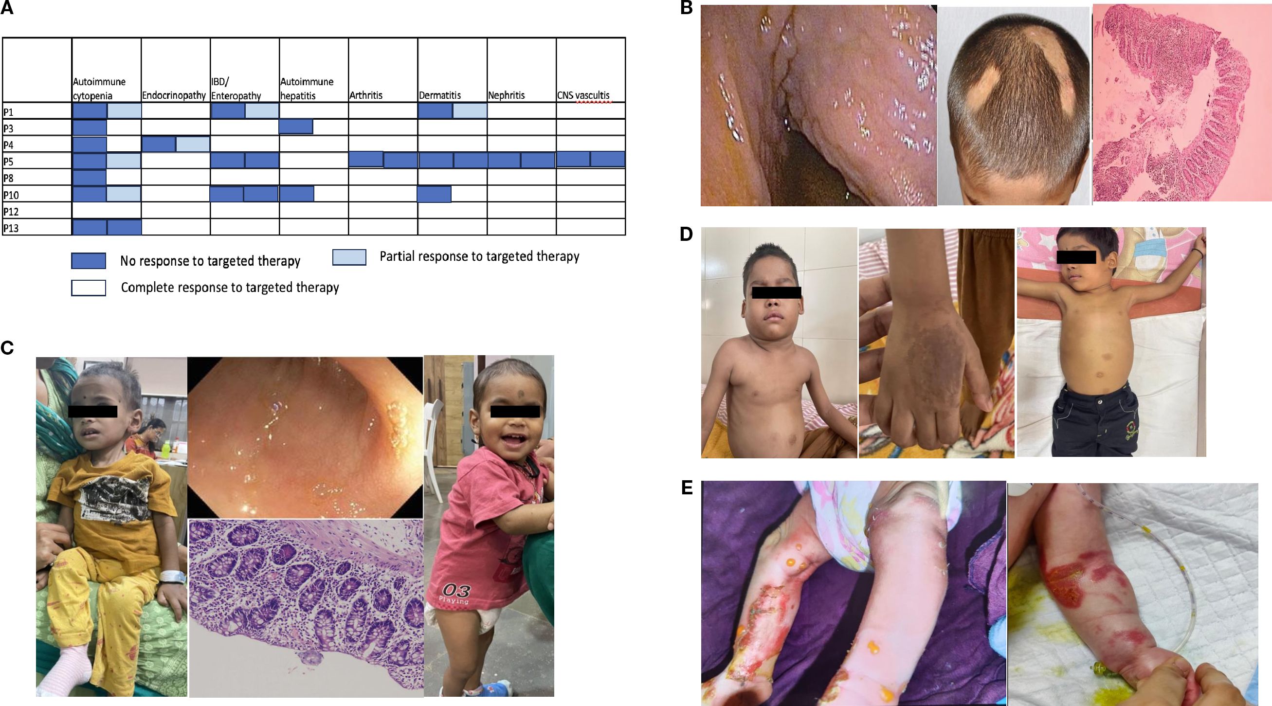A collage of medical case images: A) A table showing responses to targeted therapy for autoimmune conditions with varying degrees of responses indicated by colors. B) Photographs of skin and scalp conditions, along with a histology section of the intestine. C) Images of young children with different medical conditions, including skin and intestinal issues, and a histological image. D) Images showing a child with skin discoloration and rashes, highlighting affected areas on the body and hand. E) Close-ups of legs with severe skin conditions and ulcers, indicating medical concern.