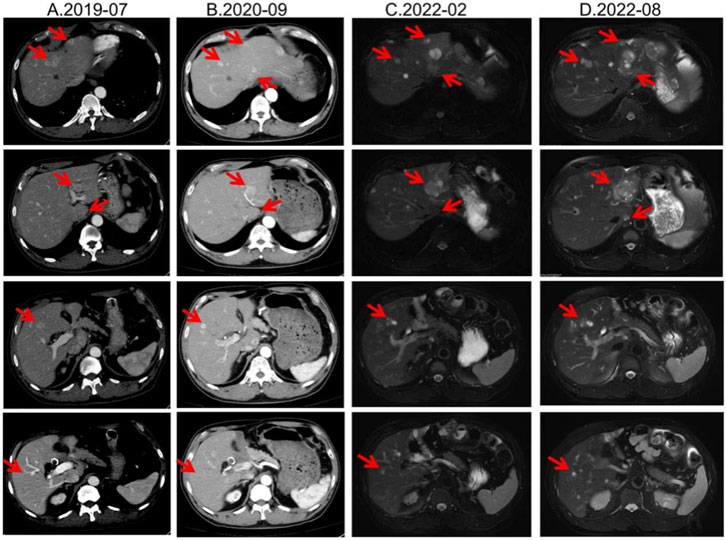 CT and MRI scan series show progression of liver lesions over time. Four columns labeled A.2019-07, B.2020-09, C.2022-02, and D.2022-08, each containing four images with red arrows indicating lesions. The images depict changes in liver morphology and lesion intensity.
