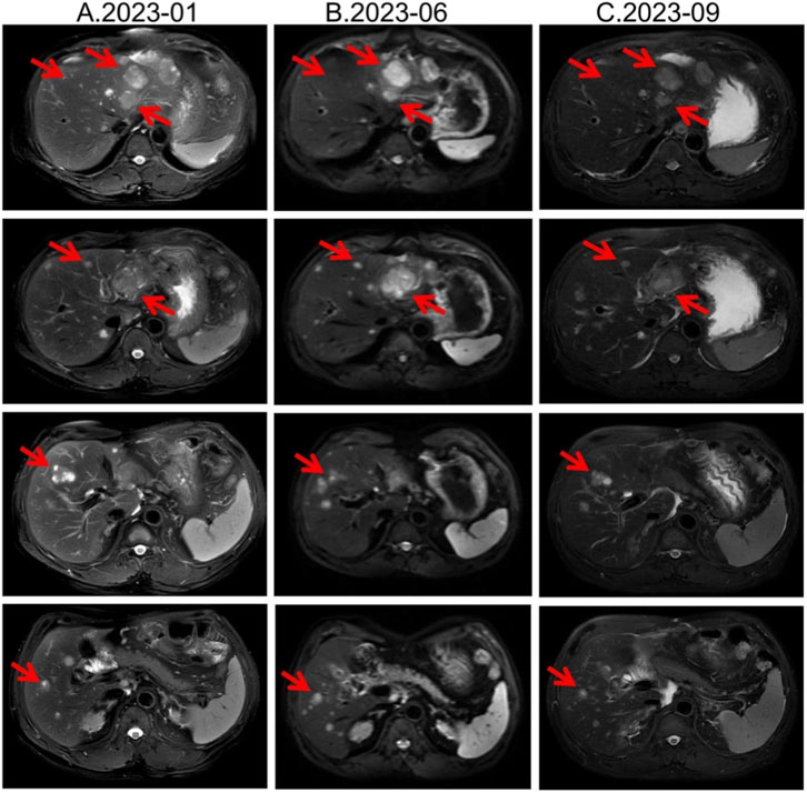 MRI scans in three columns, labeled A.2023-01, B.2023-06, and C.2023-09, showing liver changes over time. Each column contains four images with red arrows indicating specific areas of interest, likely abnormalities or changes in the liver tissue.