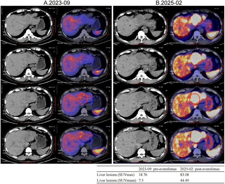 CT and PET scan images comparing liver lesions from September 2023 (left) and February 2025 (right). The scans show increased intensity and size of lesions in 2025, highlighted by red circles. The liver lesion SUVmax increased from 18.76 to 83.08, and SUVmean from 7.5 to 44.49, indicating progression post-everolimus treatment.