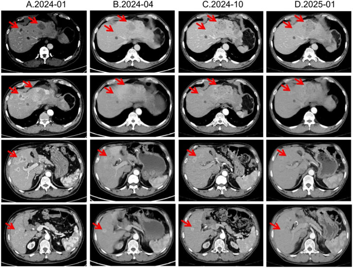 CT scan panel showing four columns labeled A.2024-01, B.2024-04, C.2024-10, and D.2025-01. Each column contains four images of abdominal cross-sections with red arrows indicating specific areas. The images show various changes over time, highlighting differences in the liver region.