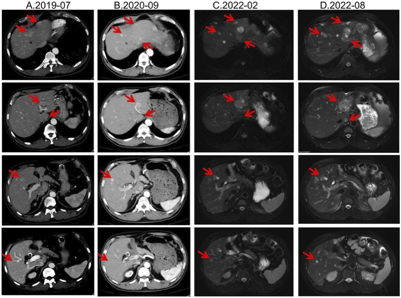 CT and MRI scan series show progression of liver lesions over time. Four columns labeled A.2019-07, B.2020-09, C.2022-02, and D.2022-08, each containing four images with red arrows indicating lesions. The images depict changes in liver morphology and lesion intensity.