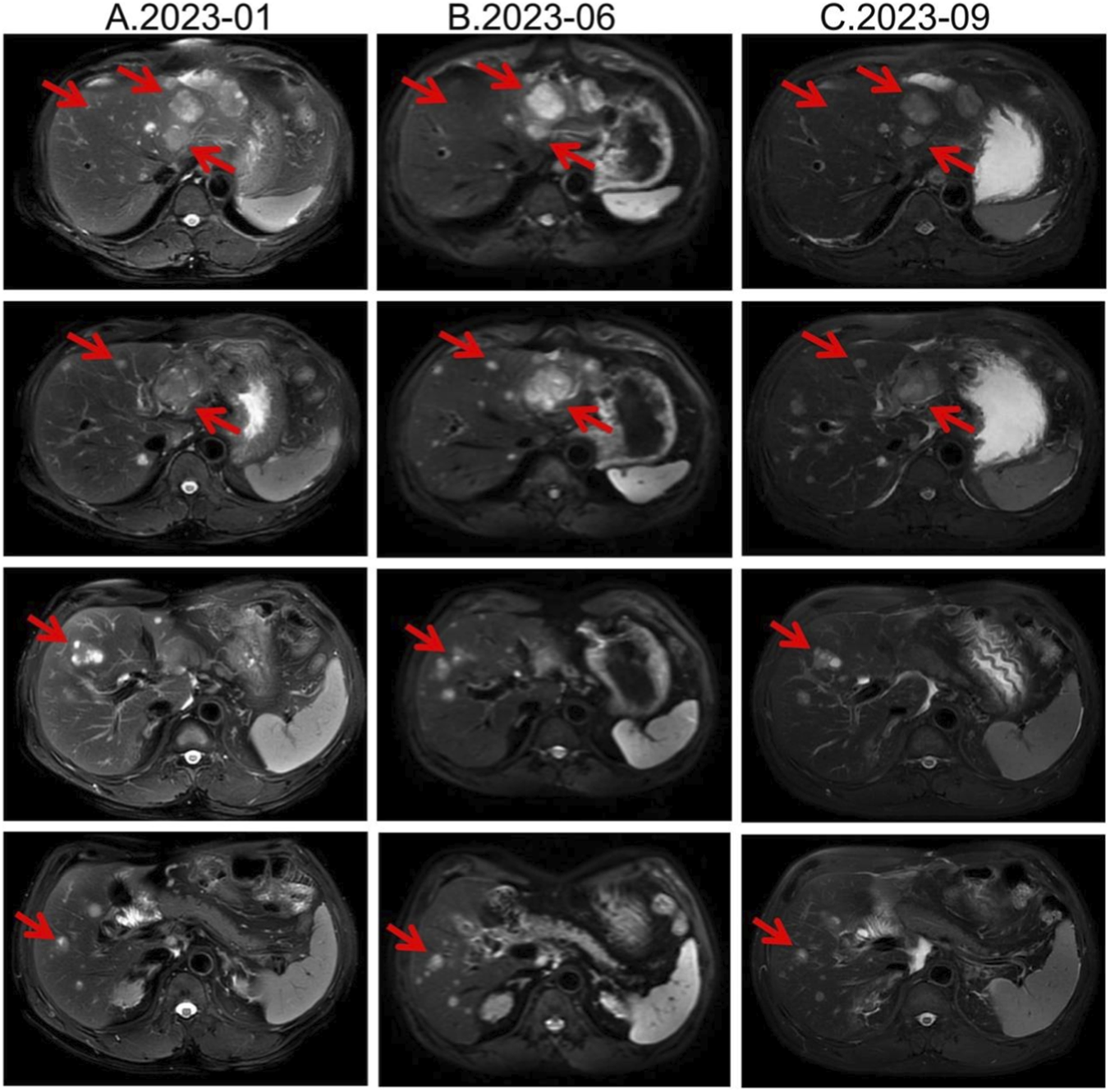 MRI scans in three columns, labeled A.2023-01, B.2023-06, and C.2023-09, showing liver changes over time. Each column contains four images with red arrows indicating specific areas of interest, likely abnormalities or changes in the liver tissue.