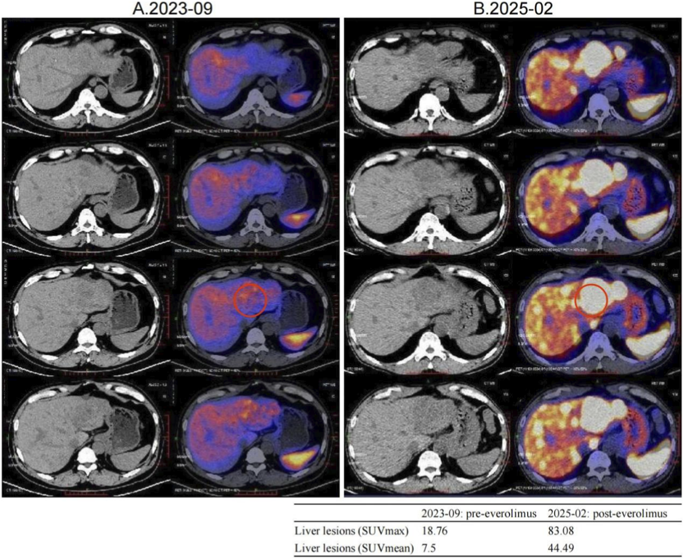 CT and PET scan images comparing liver lesions from September 2023 (left) and February 2025 (right). The scans show increased intensity and size of lesions in 2025, highlighted by red circles. The liver lesion SUVmax increased from 18.76 to 83.08, and SUVmean from 7.5 to 44.49, indicating progression post-everolimus treatment.