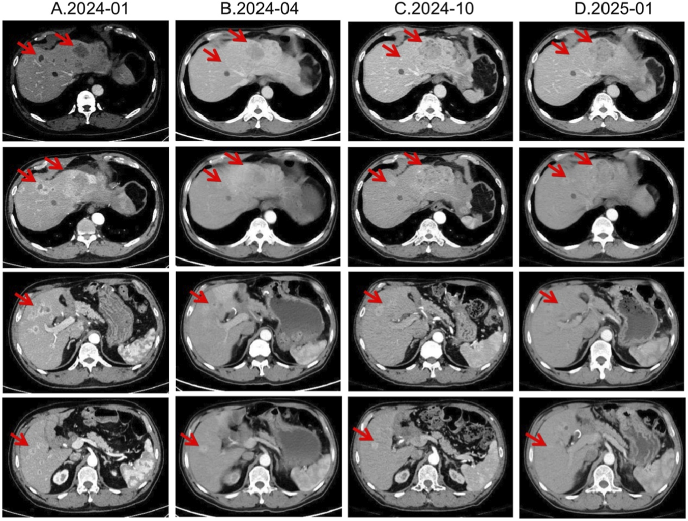 CT scan panel showing four columns labeled A.2024-01, B.2024-04, C.2024-10, and D.2025-01. Each column contains four images of abdominal cross-sections with red arrows indicating specific areas. The images show various changes over time, highlighting differences in the liver region.