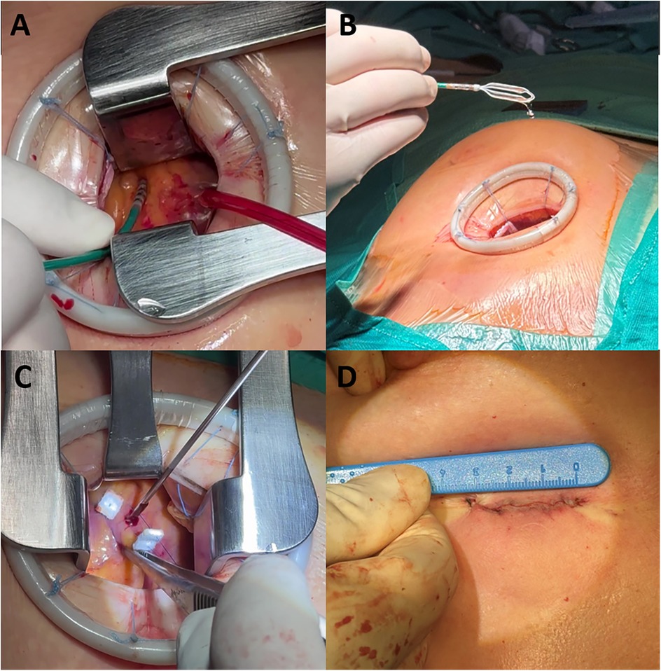 A series of four medical images depicting a hybrid surgical procedure. A: Close-up of the thoracotomy incision with retractors and ablation catheter. B: Manual manipulation of a mapping catheter. C: Biopsy instruments operating through the open surgical incision. D: A ruler measuring the closed incision, showing sutures.