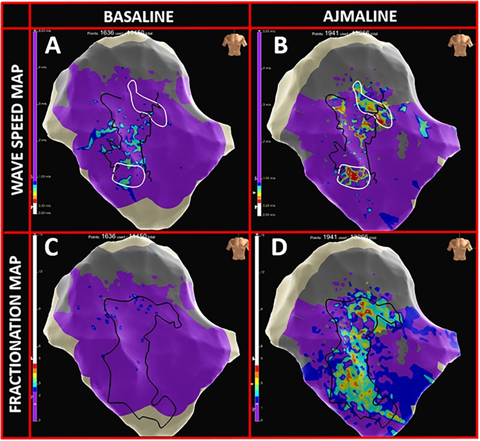 Four panels show cardiac maps comparing wave speed and fractionation before and after ajmaline administration. Panel A (baseline, wave speed) and Panel B (ajmaline, wave speed) illustrate variations in color, indicating changes in wave speed. Panel C (baseline, fractionation) and Panel D (ajmaline, fractionation) highlight shifts in fractionation patterns. The maps use shades of purple, gray, blue, and other colors to represent different data points.