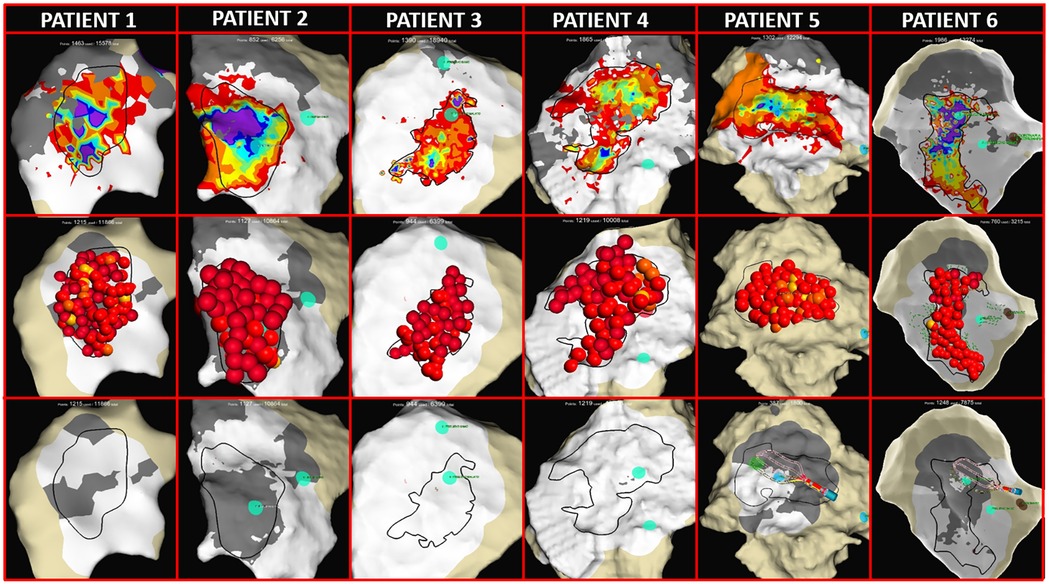 Six panels show 3D models of patient epicardial substrate with colored regions and red spheres, representing mapping data points and ablation lesions. Each column displays the substrate of each patient. The first row depict late activation mapping, the second row the ablation lesion set, the third the activation of the substrate post ablation.