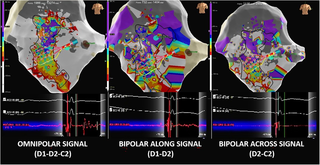 Three panels display heart mapping signals: Left shows \