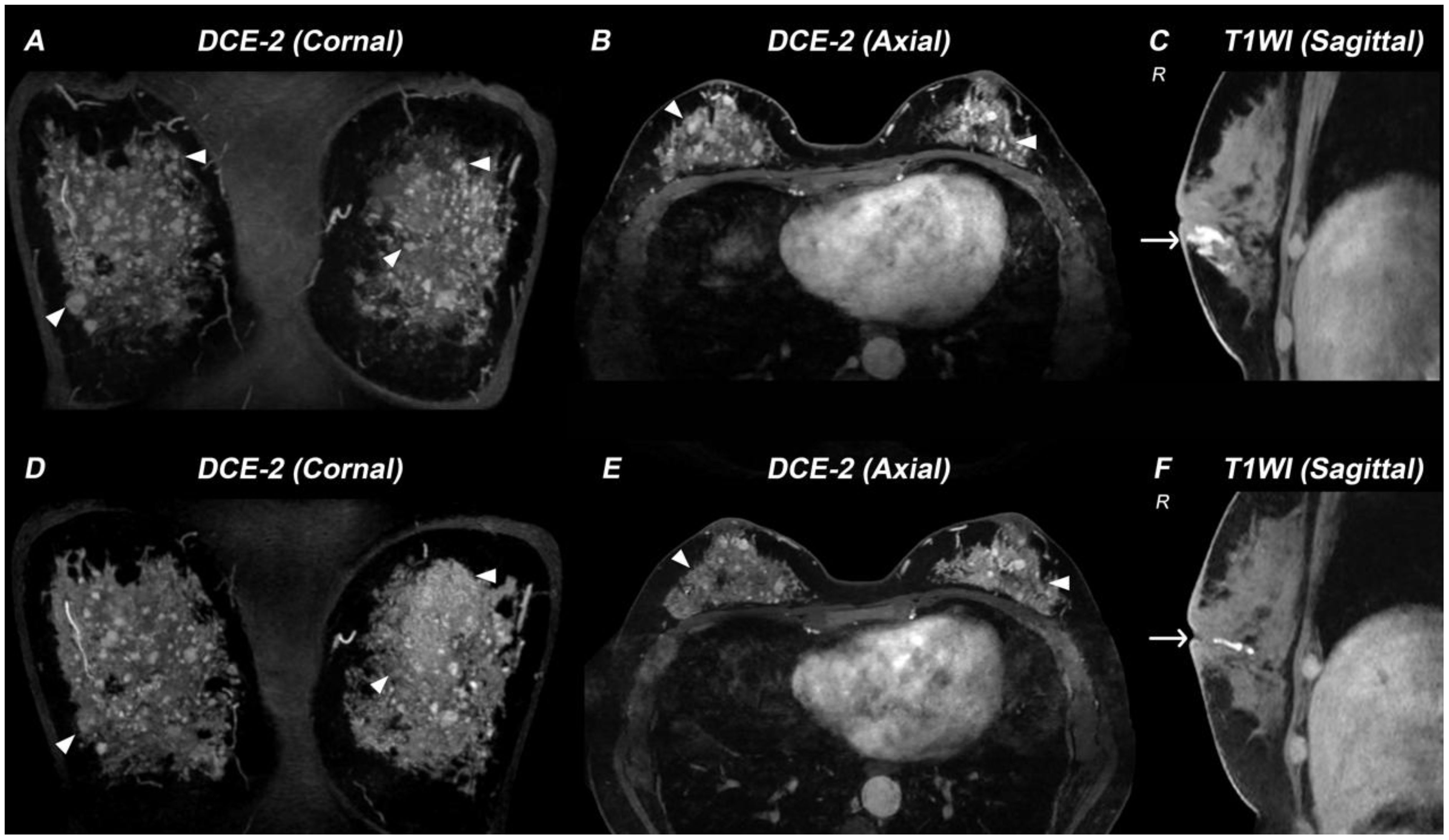 Six MRI images show breast tissue using different views and sequences. Images A and D are coronal DCE-2, B and E are axial DCE-2, and C and F are sagittal T1-weighted images. White arrows and triangles indicate areas of interest.