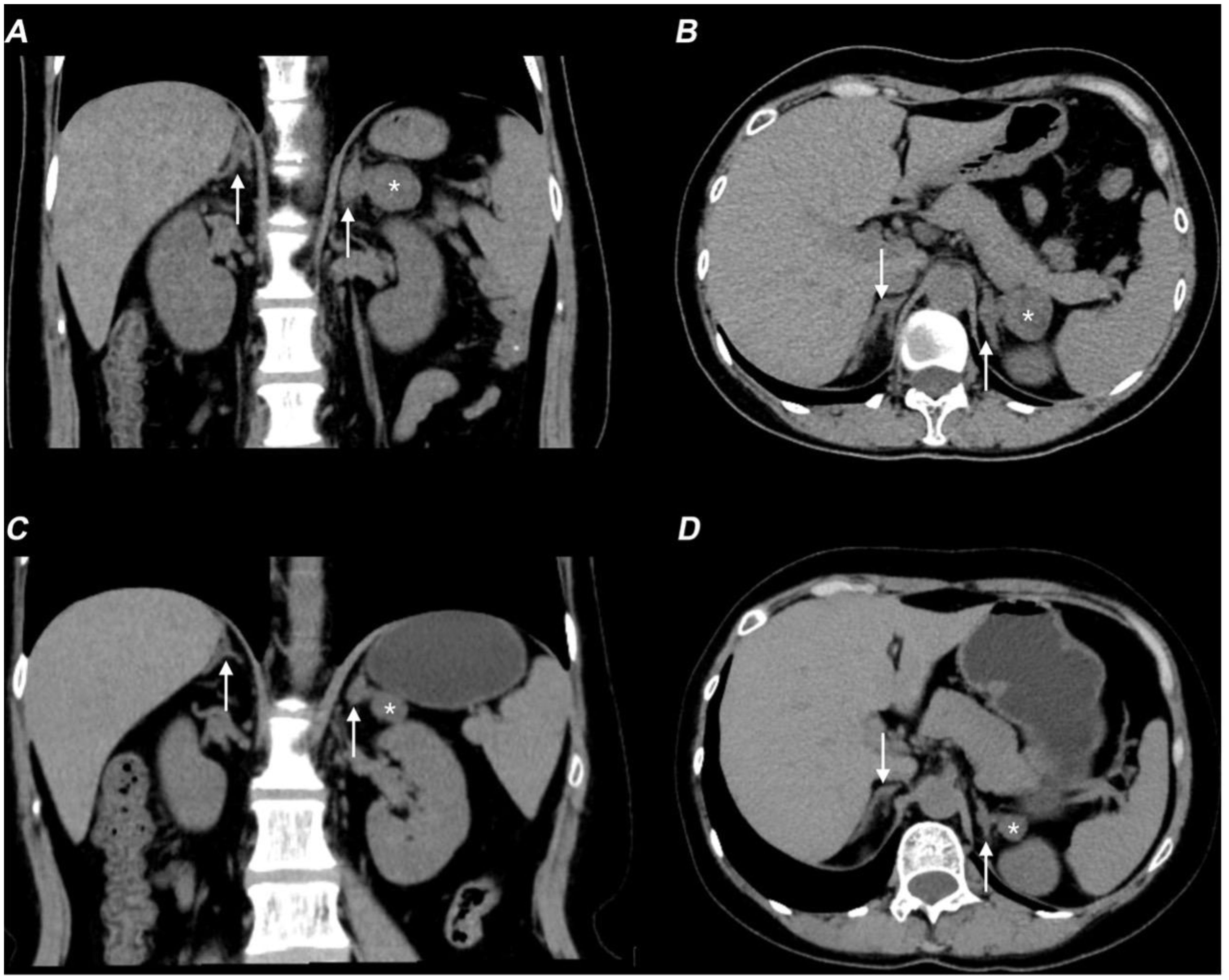 CT scan images labeled A to D show abdominal cross-sections. Panels A and C display coronal views, while B and D show axial views. Arrows and asterisks highlight specific areas, focusing on anatomical structures and potential abnormalities in the adrenal glands..