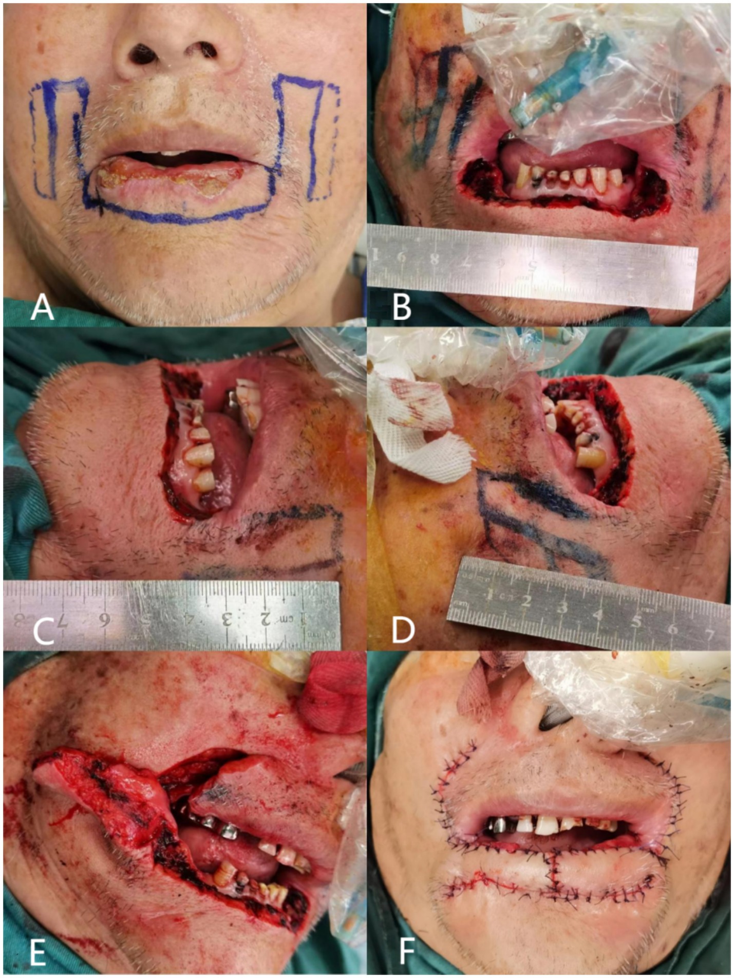 A series of surgical images showcases a lip reconstruction procedure. Image A displays pre-surgery markings on the face. Images B to E show progressive stages of the surgery, highlighting incisions and tissue manipulation with rulers for scale. Image F presents the completed procedure with sutures in place, demonstrating the surgical outcome.