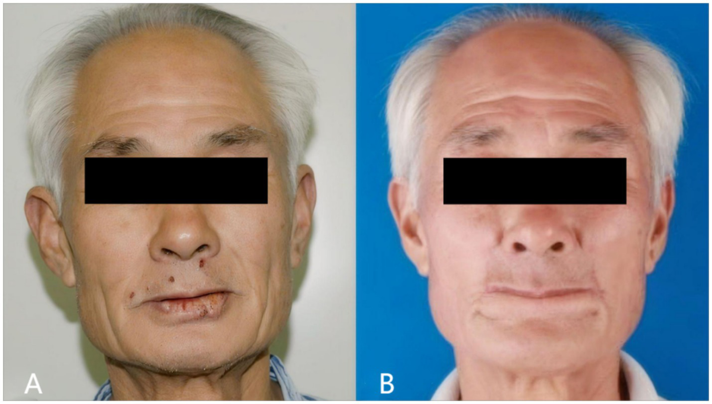 Side-by-side comparison of a man's face before and after a medical procedure. The left image (A) shows a man's face with visible scars and marks around the lips. The right image (B) displays the same man with smoother skin around the mouth area, indicating improvement. Both images have the eyes obscured for privacy.