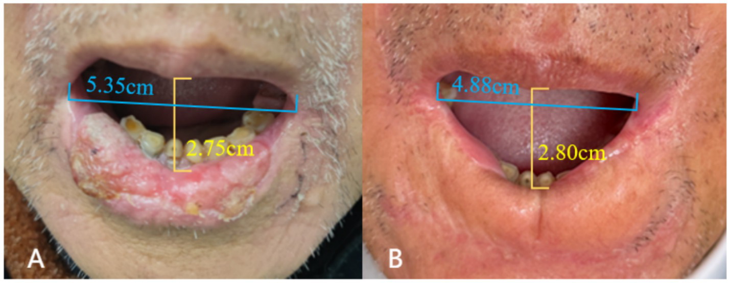 Close-up of two mouths labeled A and B, showing measurements of the oral cavity. Image A measures 5.35 centimeters wide and 2.75 centimeters tall. Image B measures 4.88 centimeters wide and 2.80 centimeters tall.