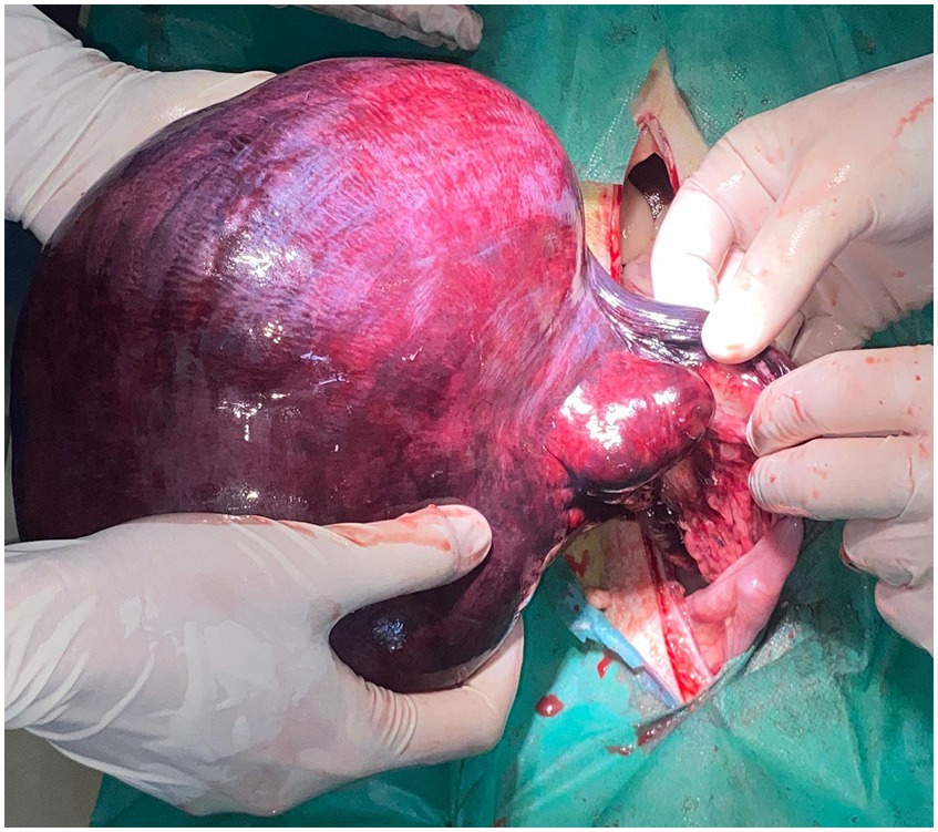 Gloved hands hold a large, dark red, glossy uterine structure during a surgical procedure. The uterus appears swollen, and there is an incision in the green surgical drape beneath it.